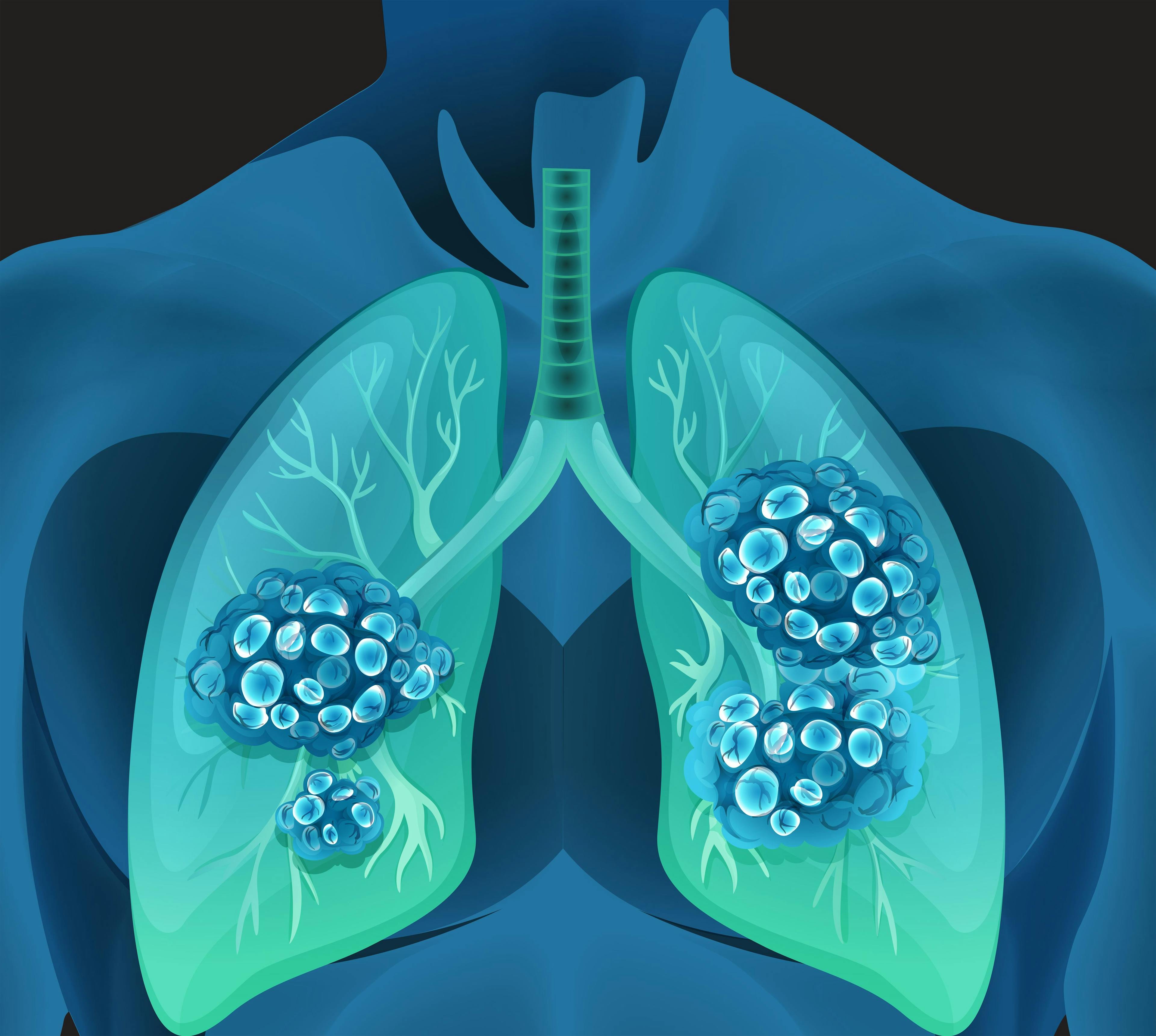 Lung cancer in human body | | Image Credit: © blueringmedia -www.stock.adobe.com