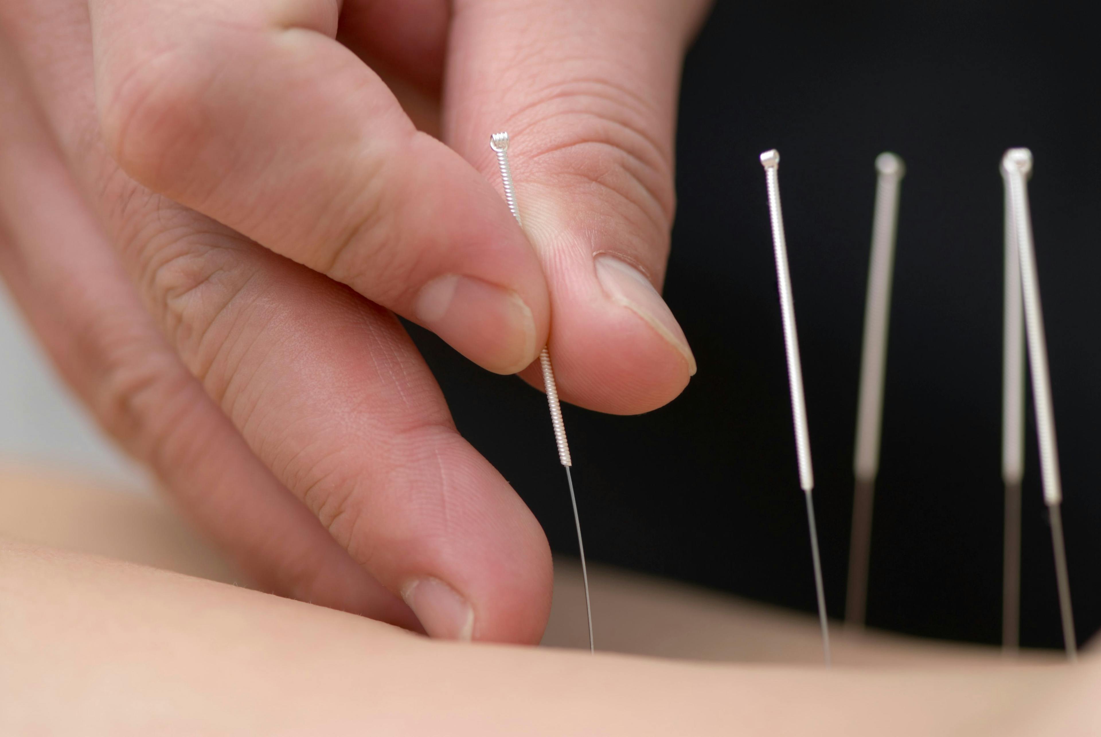 treatment by acupuncture | Image Credit: © Max Tactic - www.stock.adobe.com