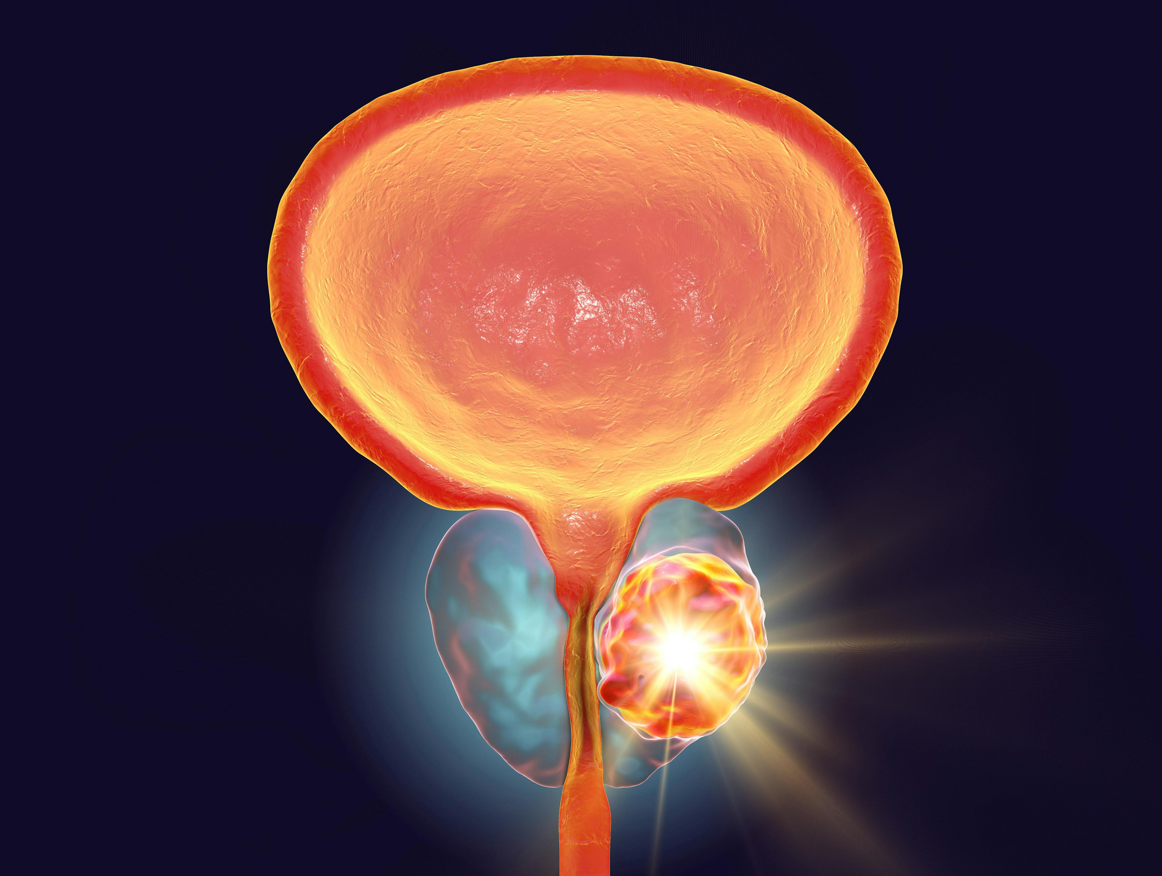 3D illustration of a tumor in the prostate gland: ©Dr_Microbe - stock. adobe.com