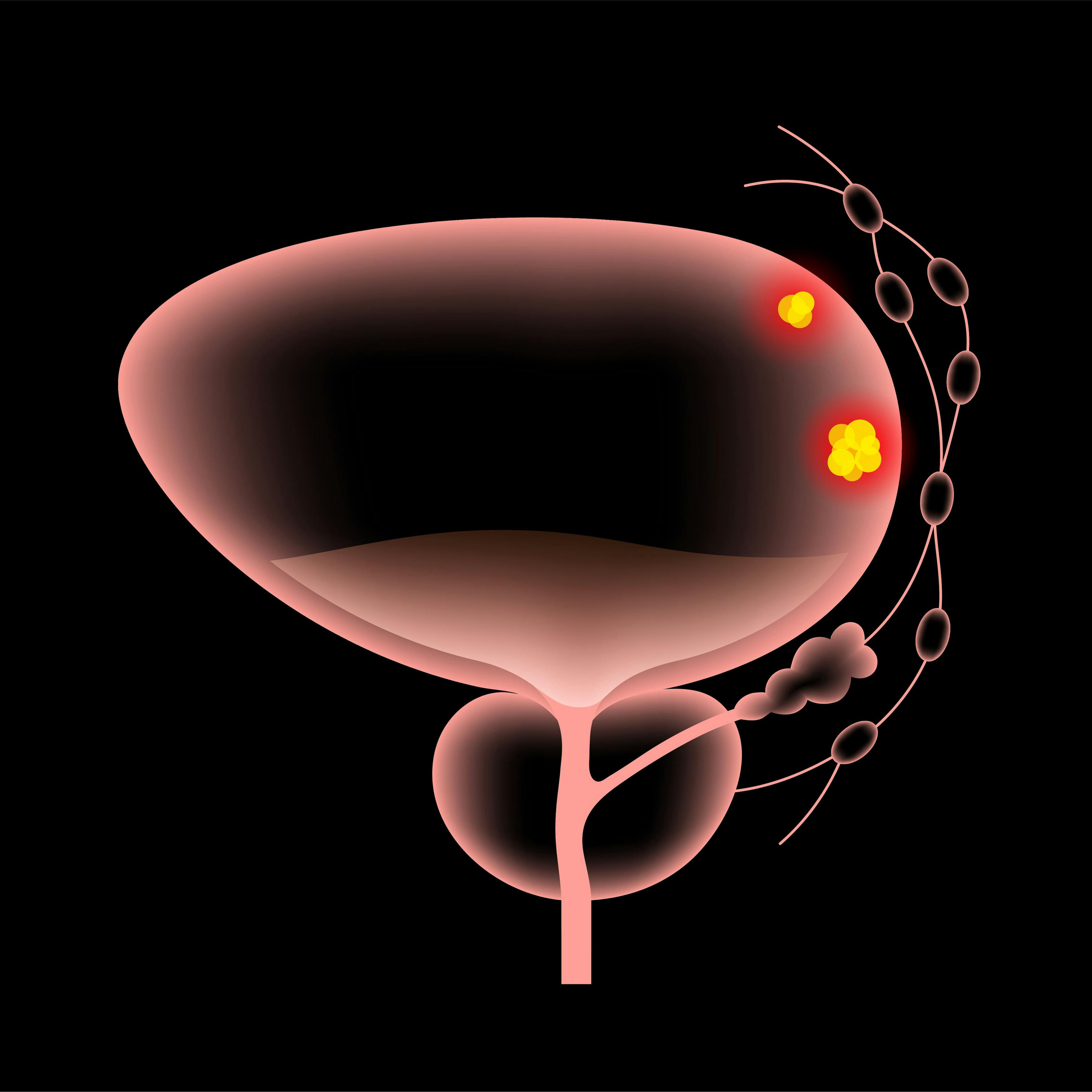 3D illustration of bladder cancer: © pikovit - stock.adobe.com