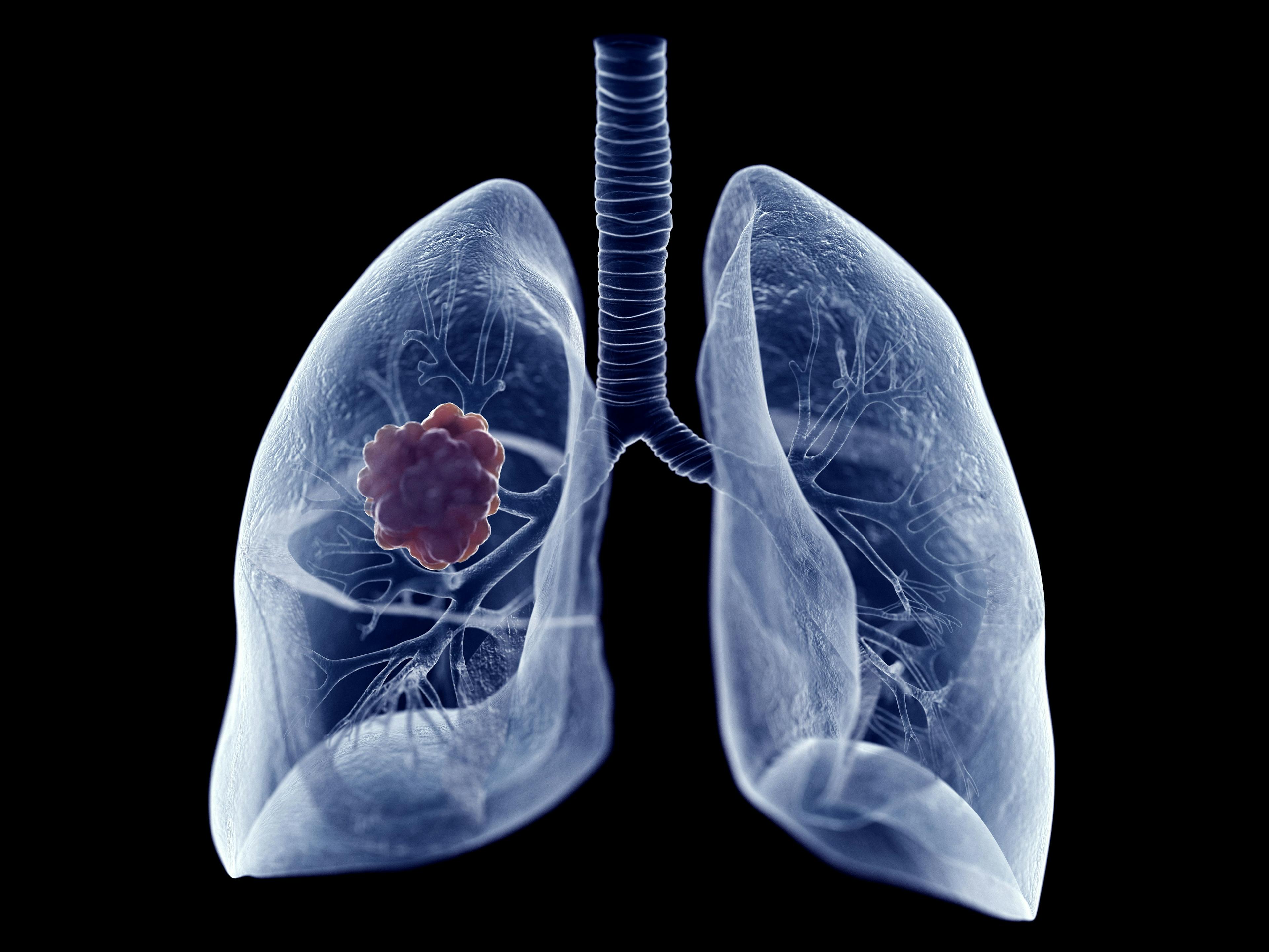 3D illustration of lung tumor © SciePro - stock.adobe.com
