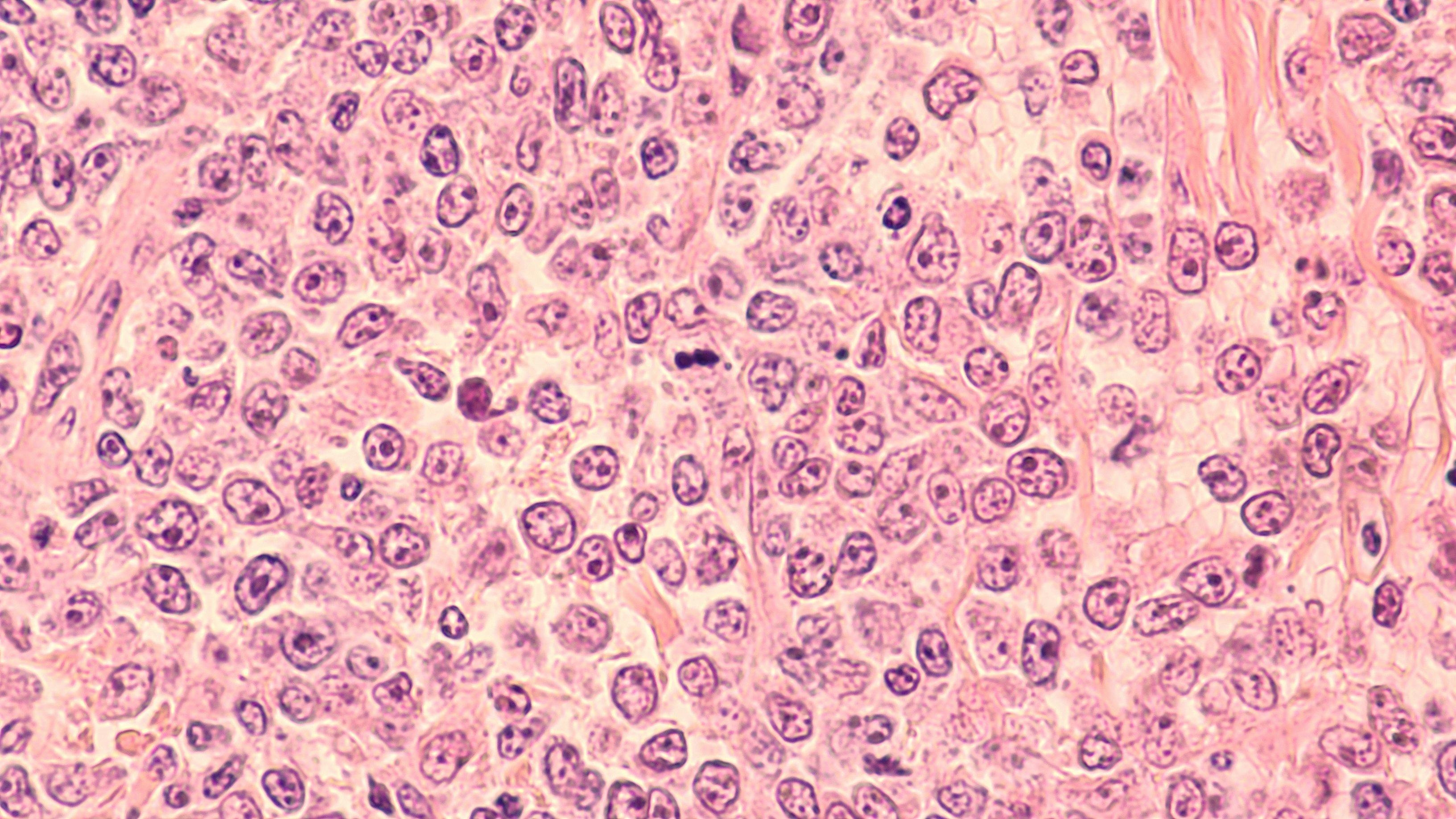 Lymphoma awareness: photomicrograph of a diffuse large B-cell lymphoma (DLBCL) a type of non-Hodgkin lymphoma. This case is from the testis of an elderly man and shows prominent nucleoli | Image Credit: © David A Litman - stock.adobe.com
