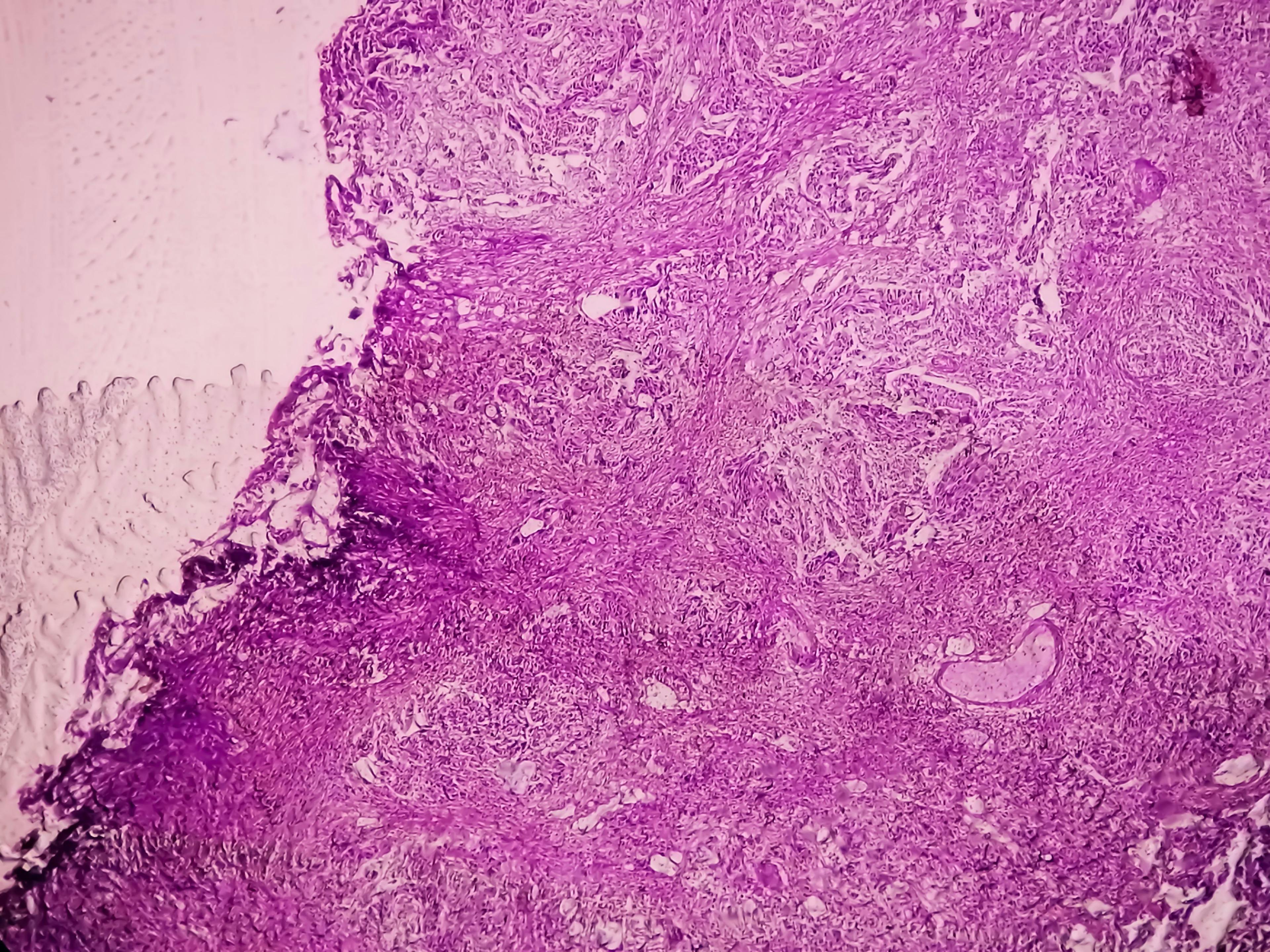 Bladder Cancer: High grade transitional cell carcinoma (TCC), Urothelial carcinoma | Image Credit: © Saiful52 -www.stock.adobe.com