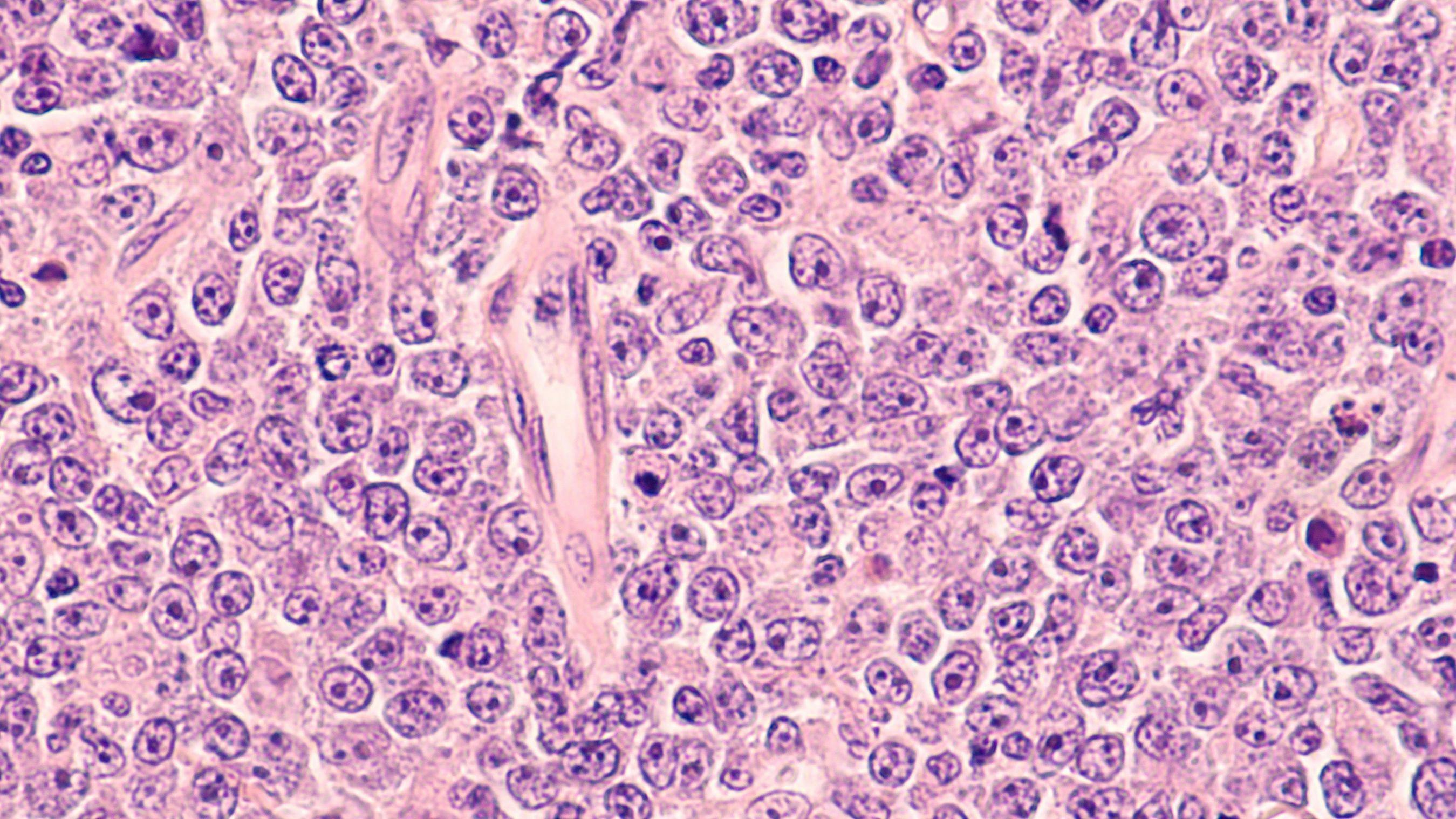 Lymphoma awareness: photomicrograph of a diffuse large B-cell lymphoma (DLBCL) a type of non-Hodgkin lymphoma. This case is from the testis of an elderly man and shows prominent nucleoli. Image Credit: © David A Litman - stock.adobe.com