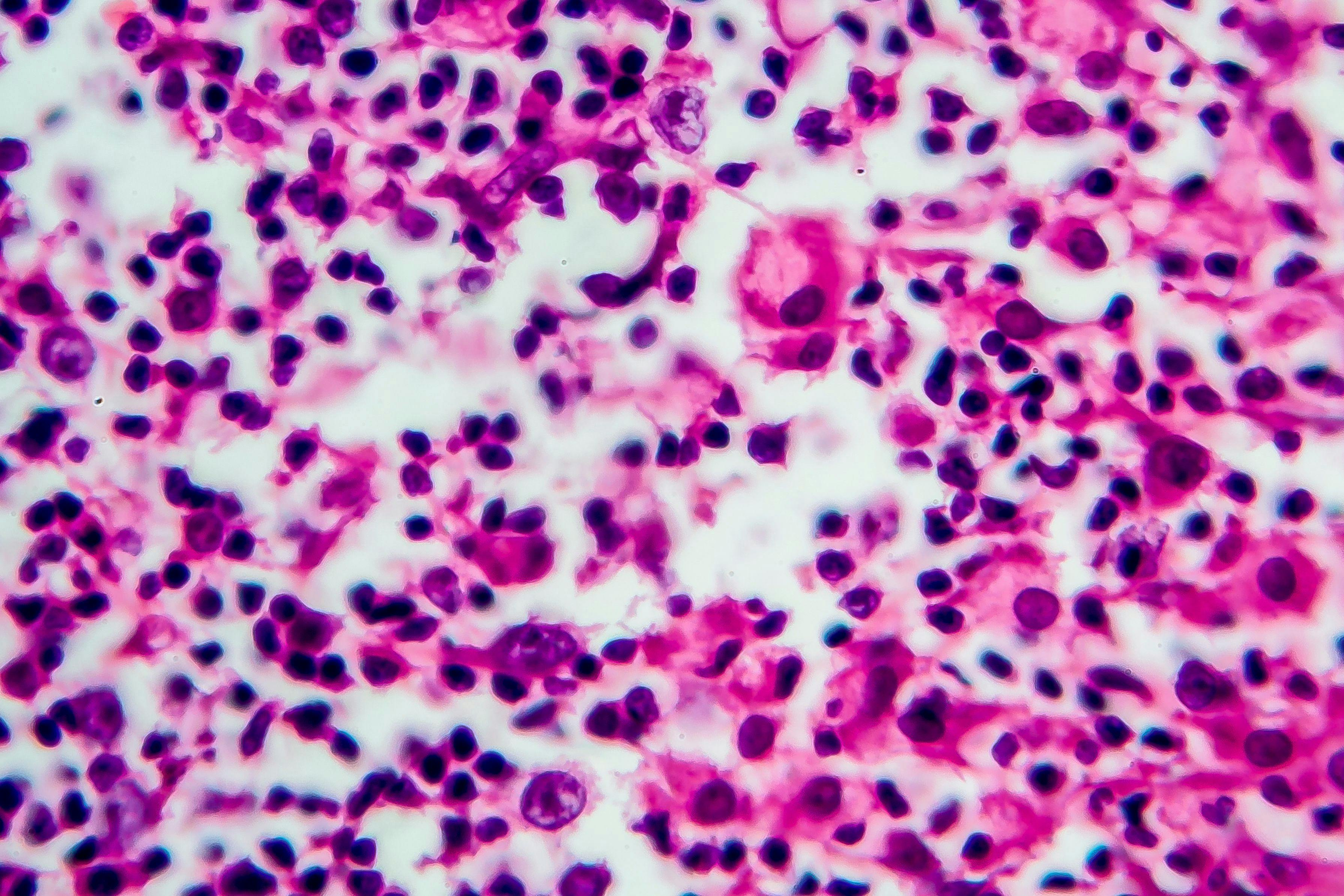 Hodgkin's lymphoma © Dr_Microbe - stock.adobe.com
