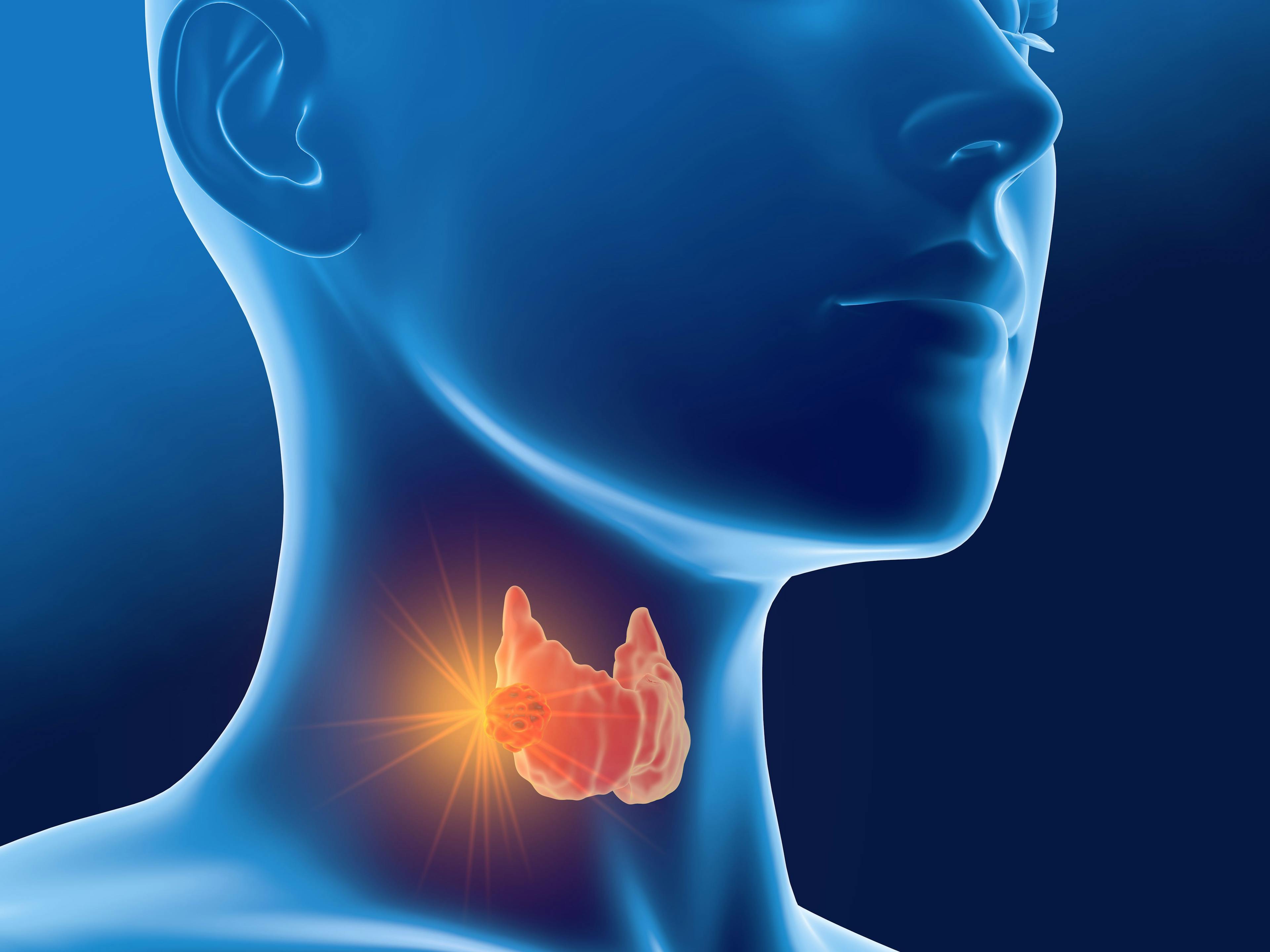 Thyroid cancer, medically 3D illustration, front view: © Axel Kock - stock.adobe.com