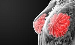 Triple-Negative Breast Cancer: Case 2