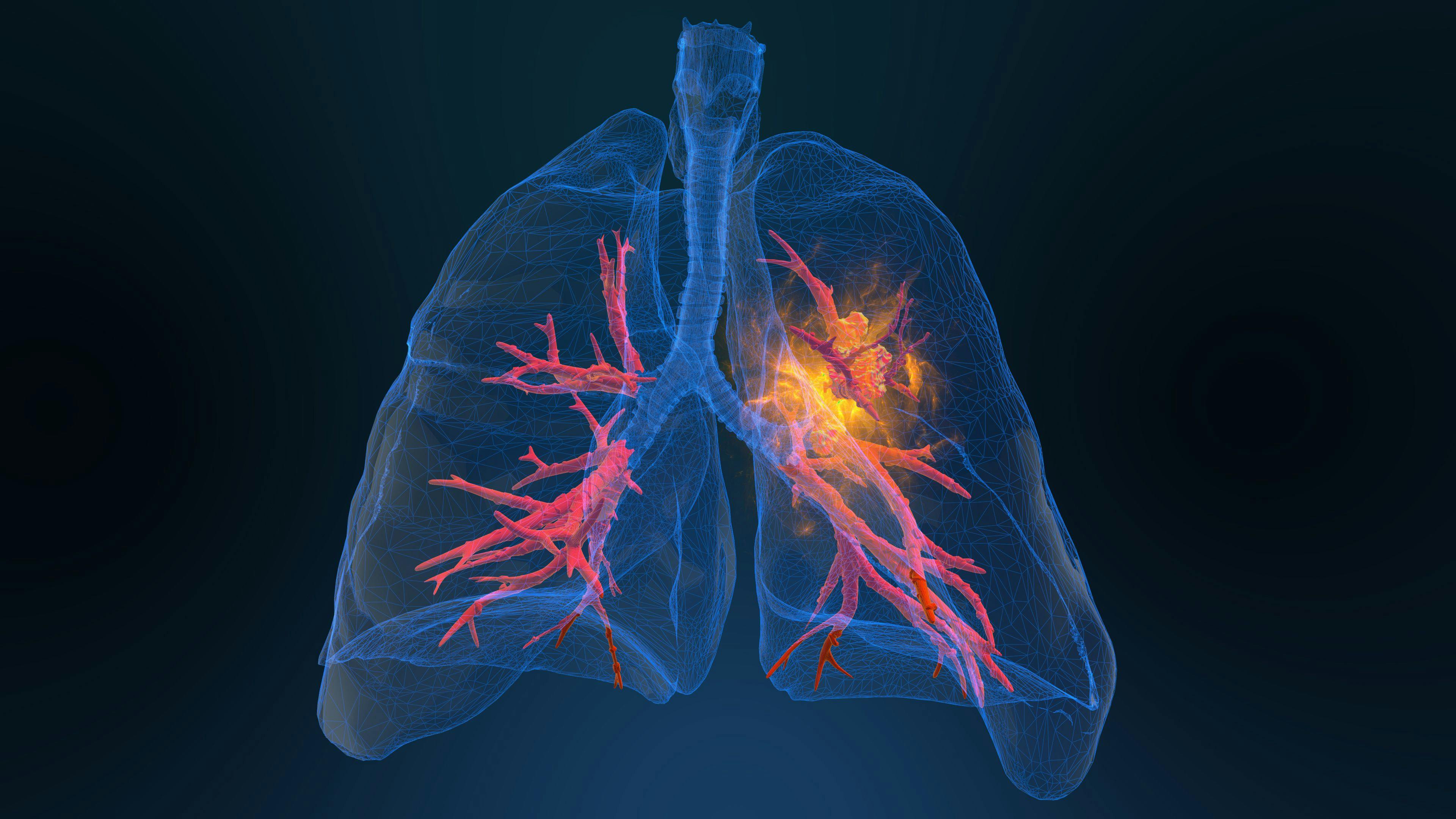 3D rendered illustration of lung cancer: ©appledesign - stock.adobe.com