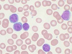 Peripheral blood smear showing CLL cells
