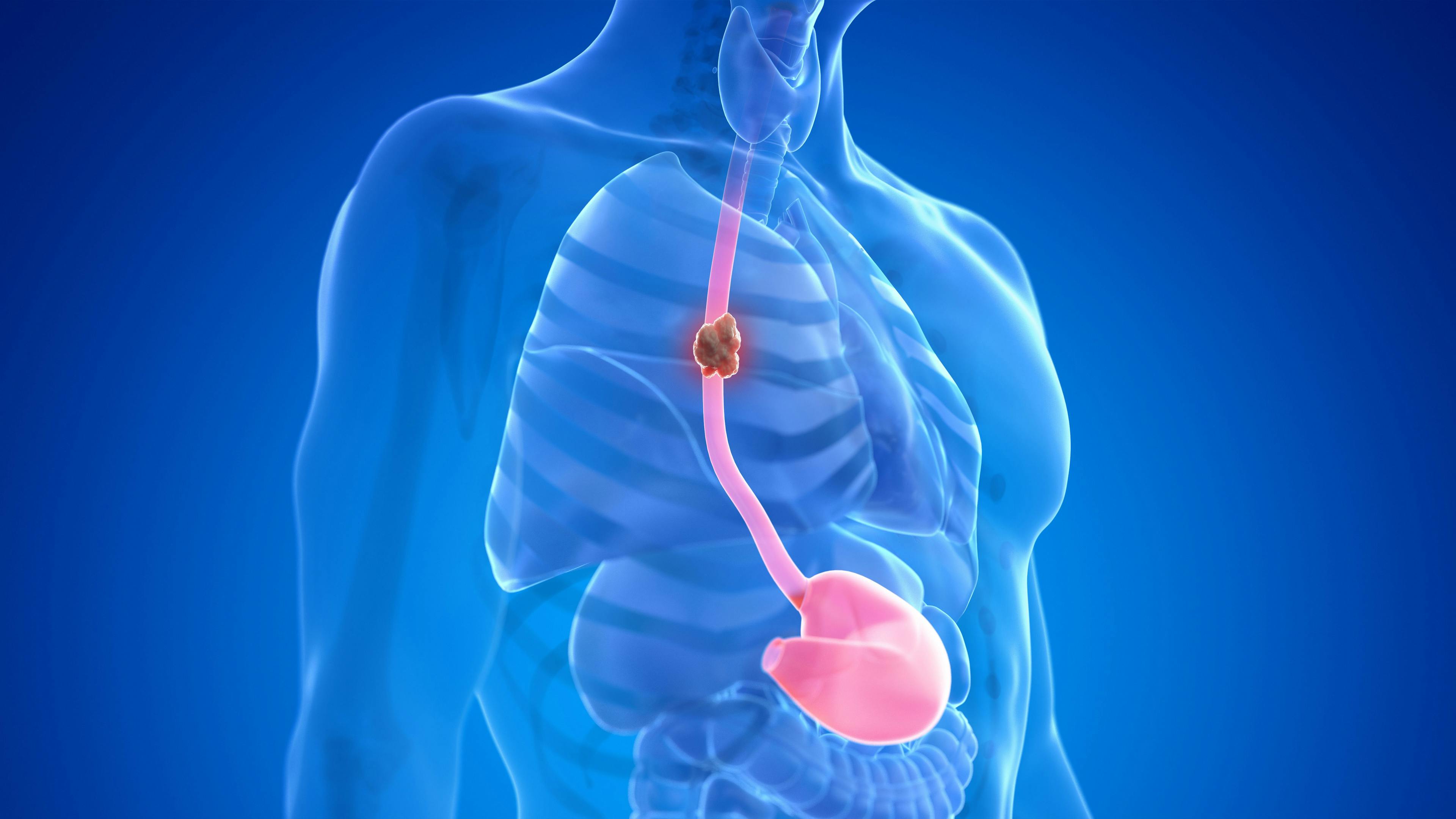3D rendered medically accurate illustration of esophagus cancer: © Sebastian Kaulitzki - stock.adobe.com
