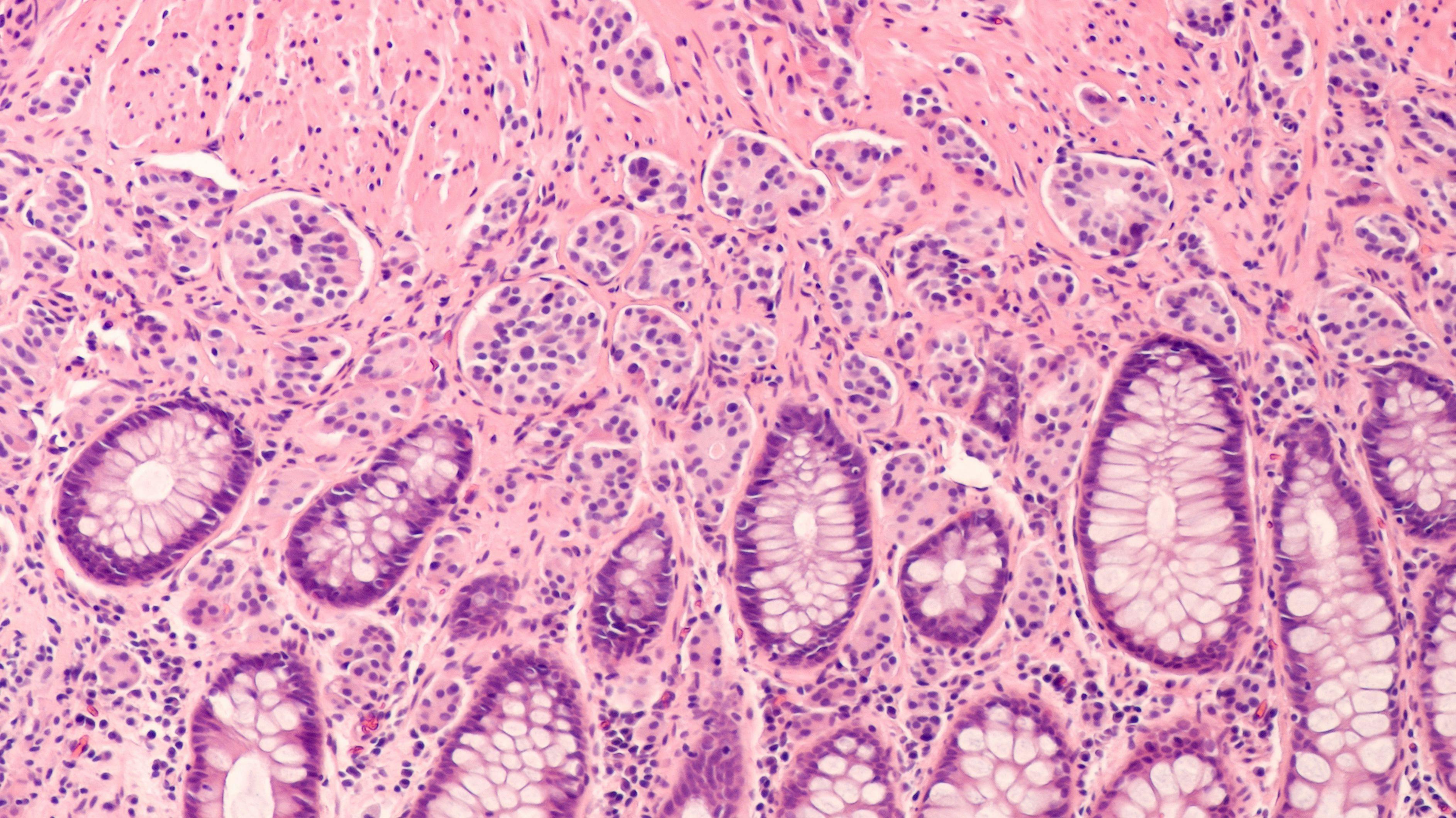 Photomicrograph of a carcinoid tumor, a type of neuroendocrine tumor (NET), which presented as a colon polyp during routine colonoscopy. Spread to liver can cause symptoms of carcinoid syndrome. | Image Credit: © David A Litman - www.stock.adobe.com