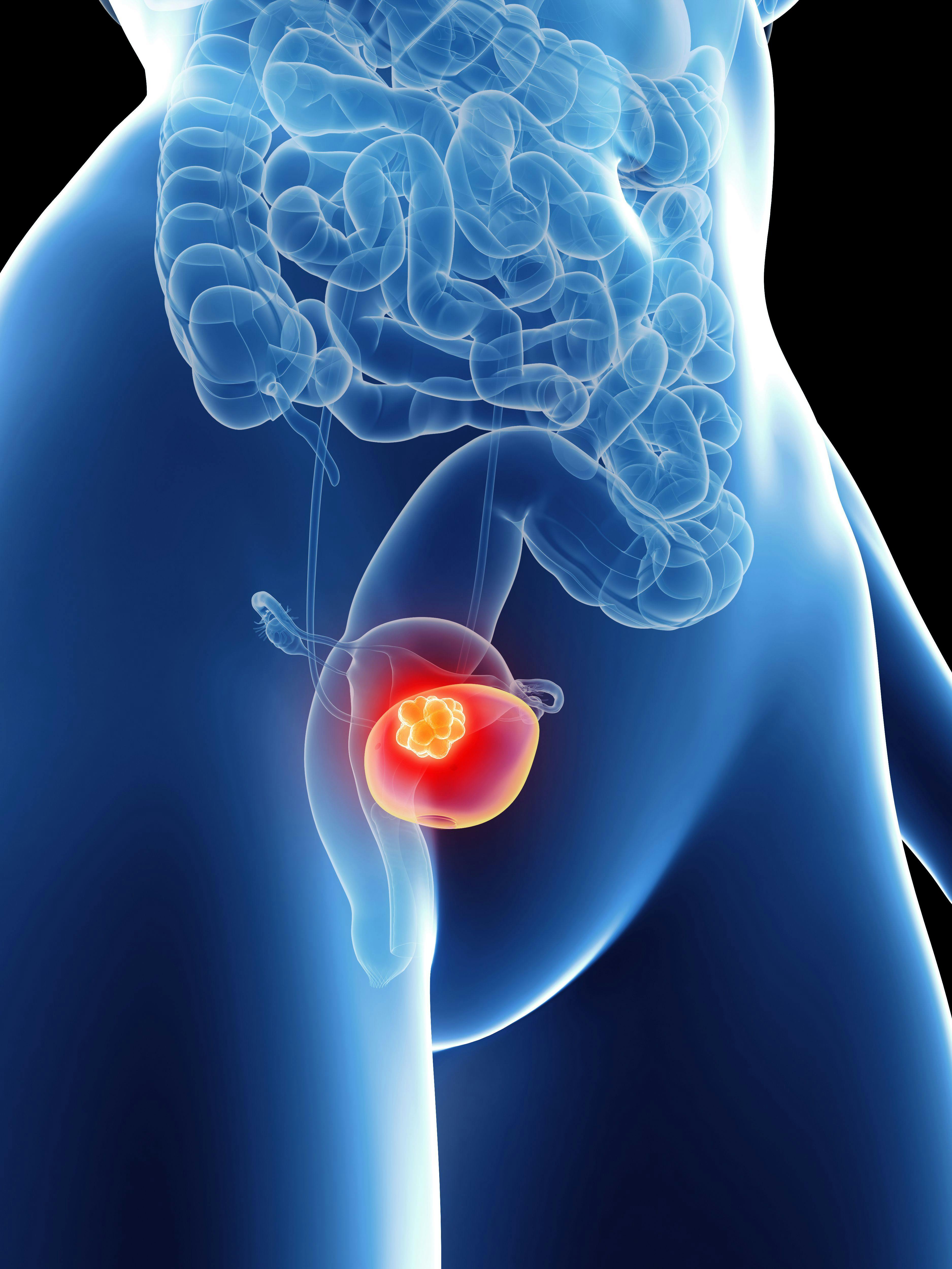 Illustration of bladder cancer: ©vitanovski - stock.adobe.com