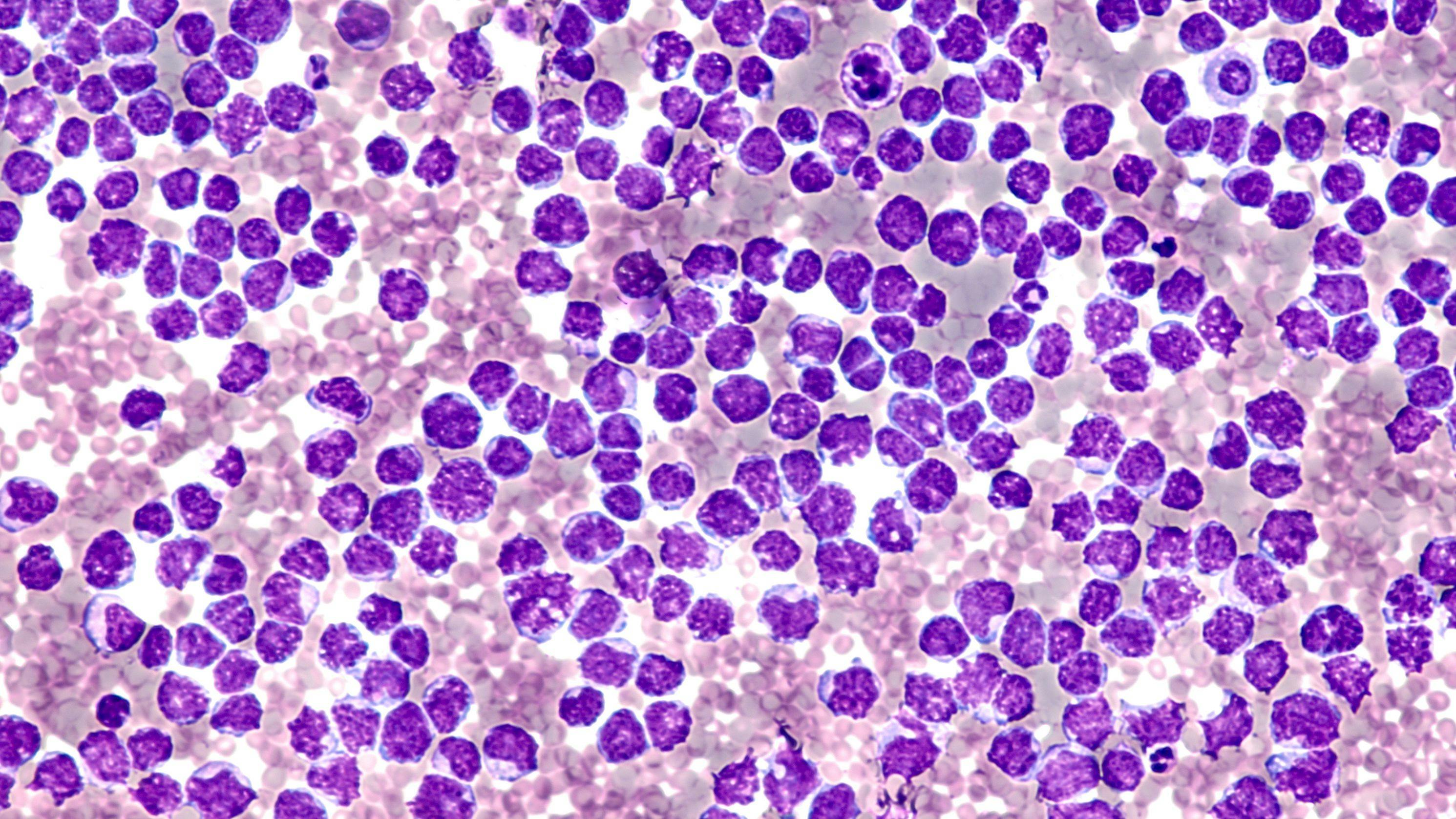 Pleural fluid cytology showing involvement by malignant cells of a mantle cell lymphoma, pleomorphic variant. | Image Credit: © David A. Litman - www.stock.adobe.com