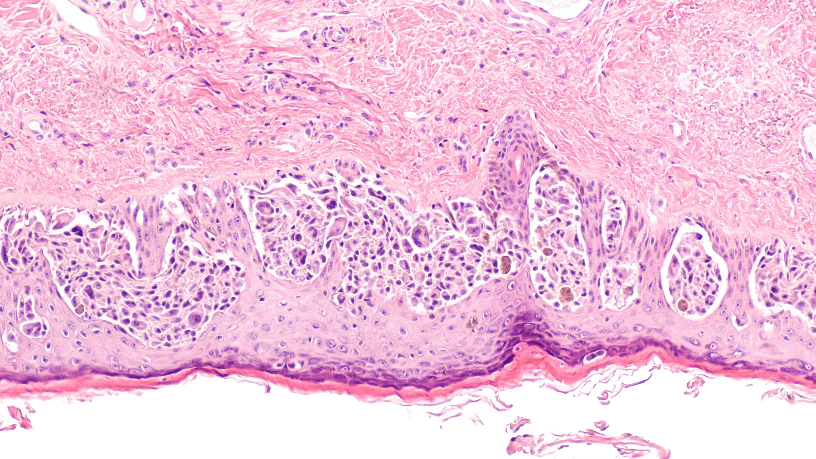 Image of melanoma cells: © David A Litman - stock.adobe.com