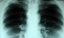 Necitumumab as First-Line Therapy Improves Overall Survival in Metastatic NSCLC