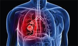 Anti-PD-1 Antibody MK-3475 Shows Promise in NSCLC