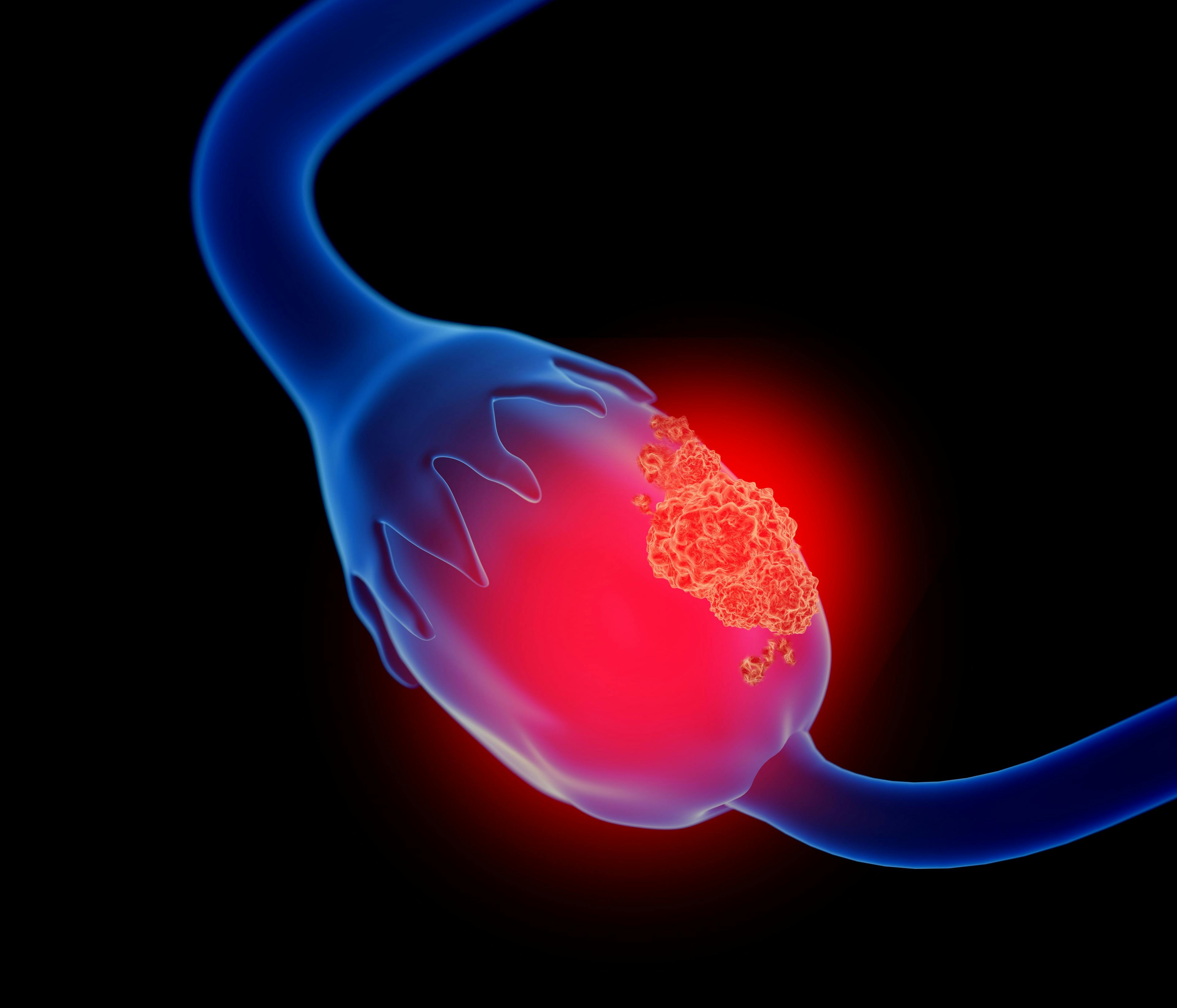 3d illustration of ovarian cancer | Image Credit: © Lars Neumann -www.stock.adobe.com
