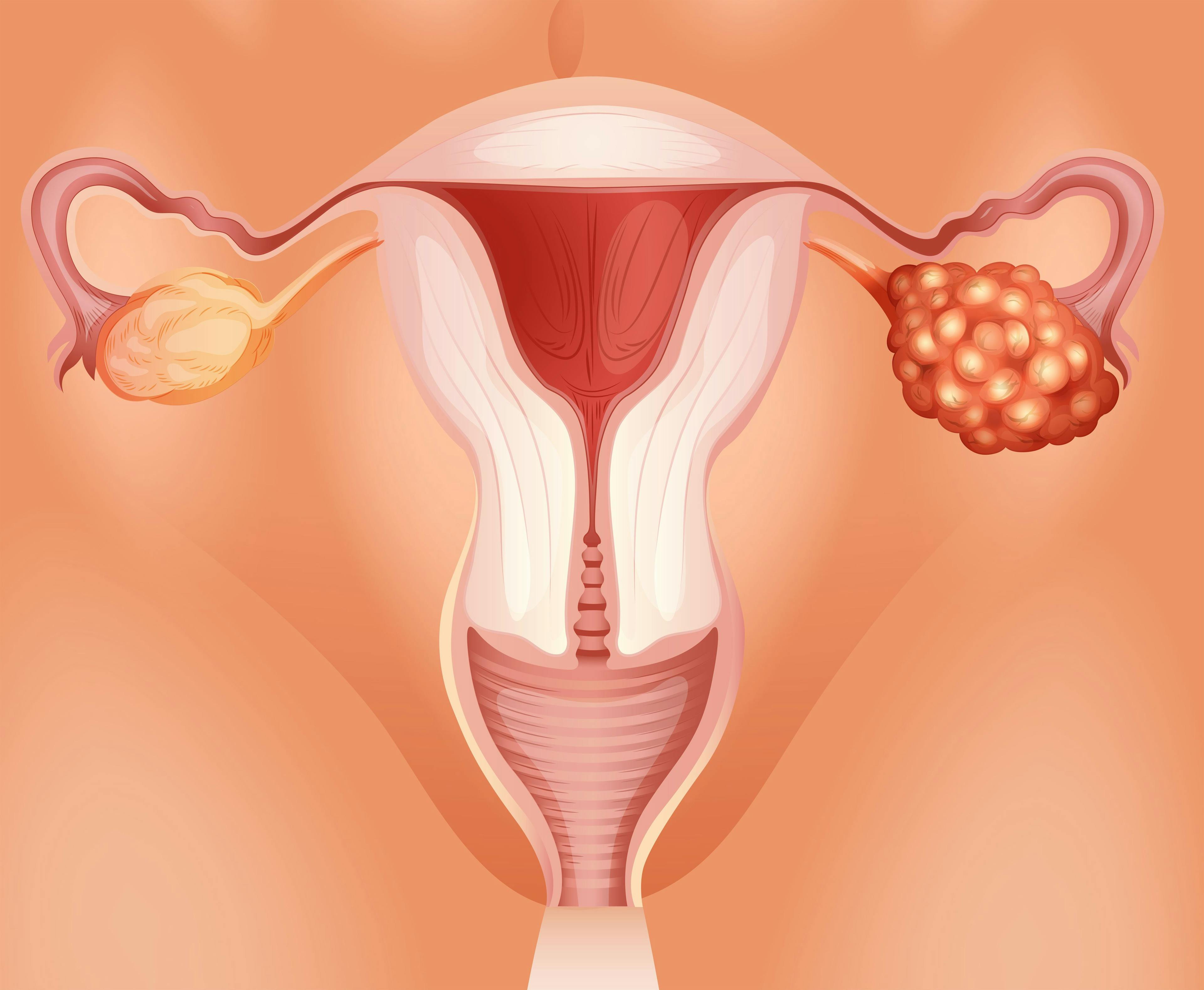 Sketch of ovarian cancer - stock.adobe.com