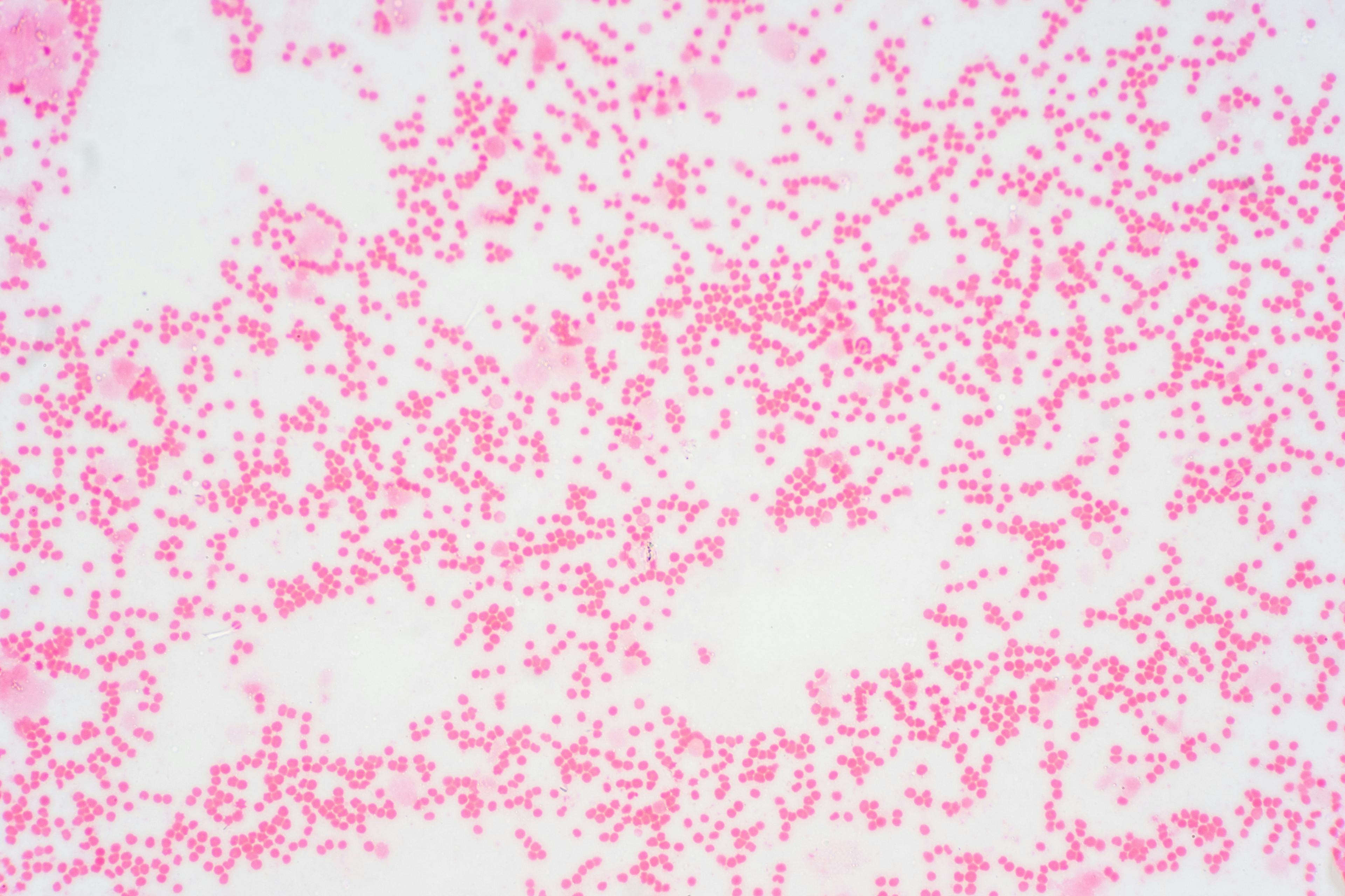 Bone marrow biopsy from myelodysplastic condition under the microscope view. | Image Credit: © tonaquatic - www.stock.adobe.com