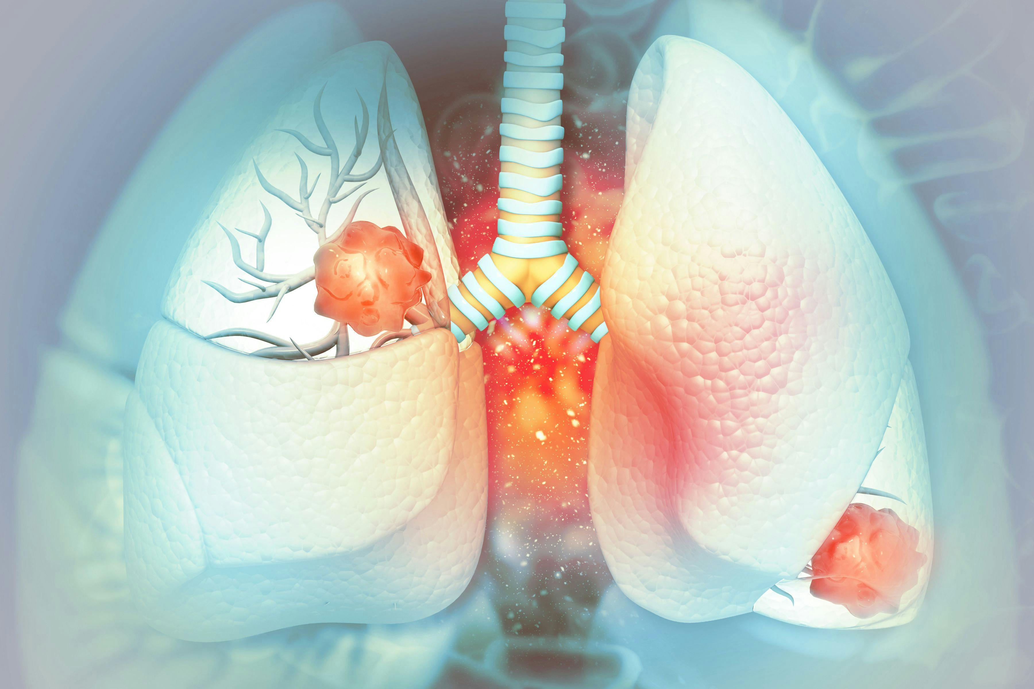 3D illustration of lung cancer: © Crystal Light - stock.adobe.com
