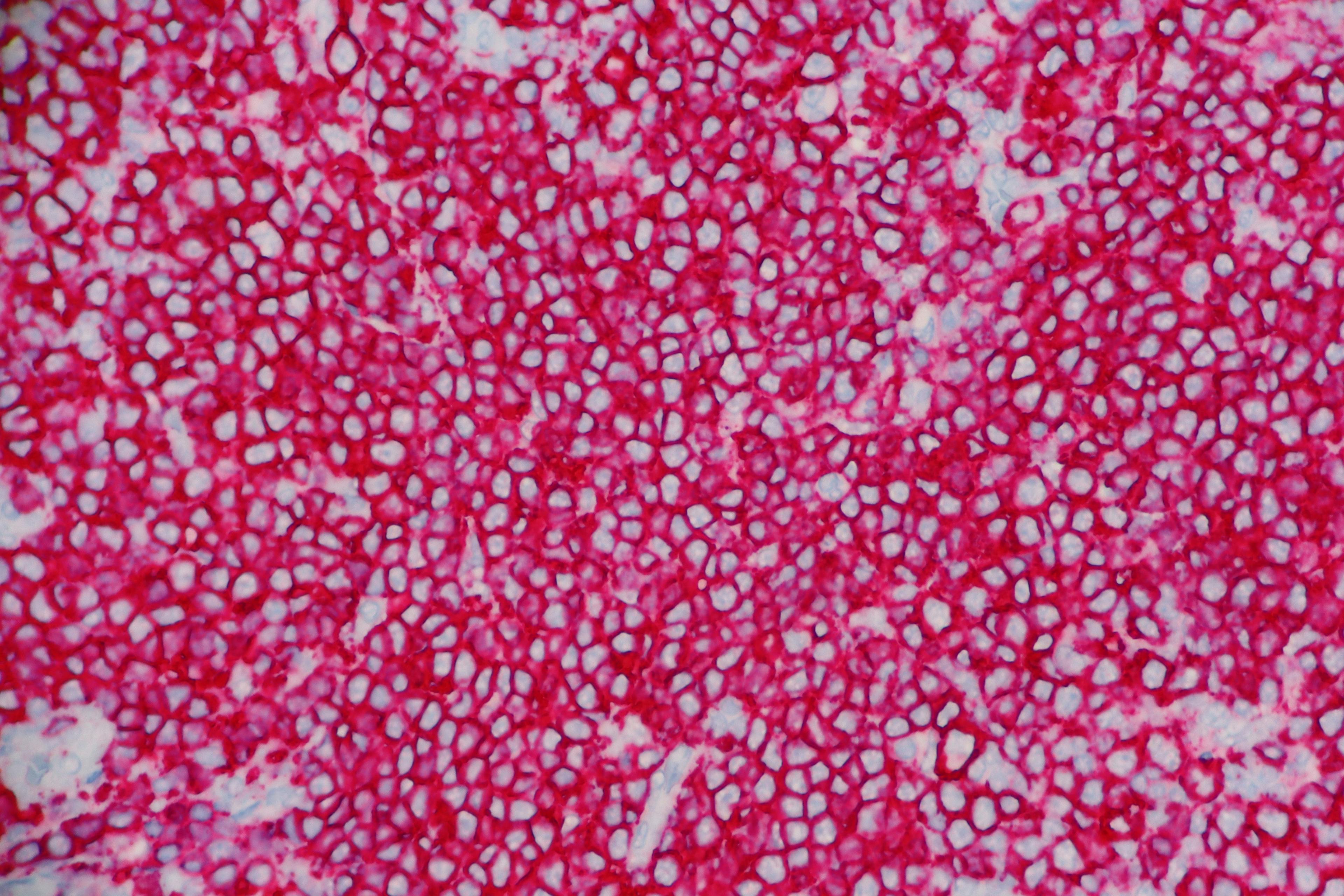 Image Credit: © Lisa - www.stock.adobe.com | High grade follicular lymphoma with diffuse Membrane expression (red) of the B-cell marker called CD 20. The nuclei appear light blue in this stain. Microscopic view