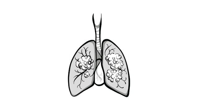 Dato-DXd Outperforms Docetaxel in Nonsquamous Lung Cancer