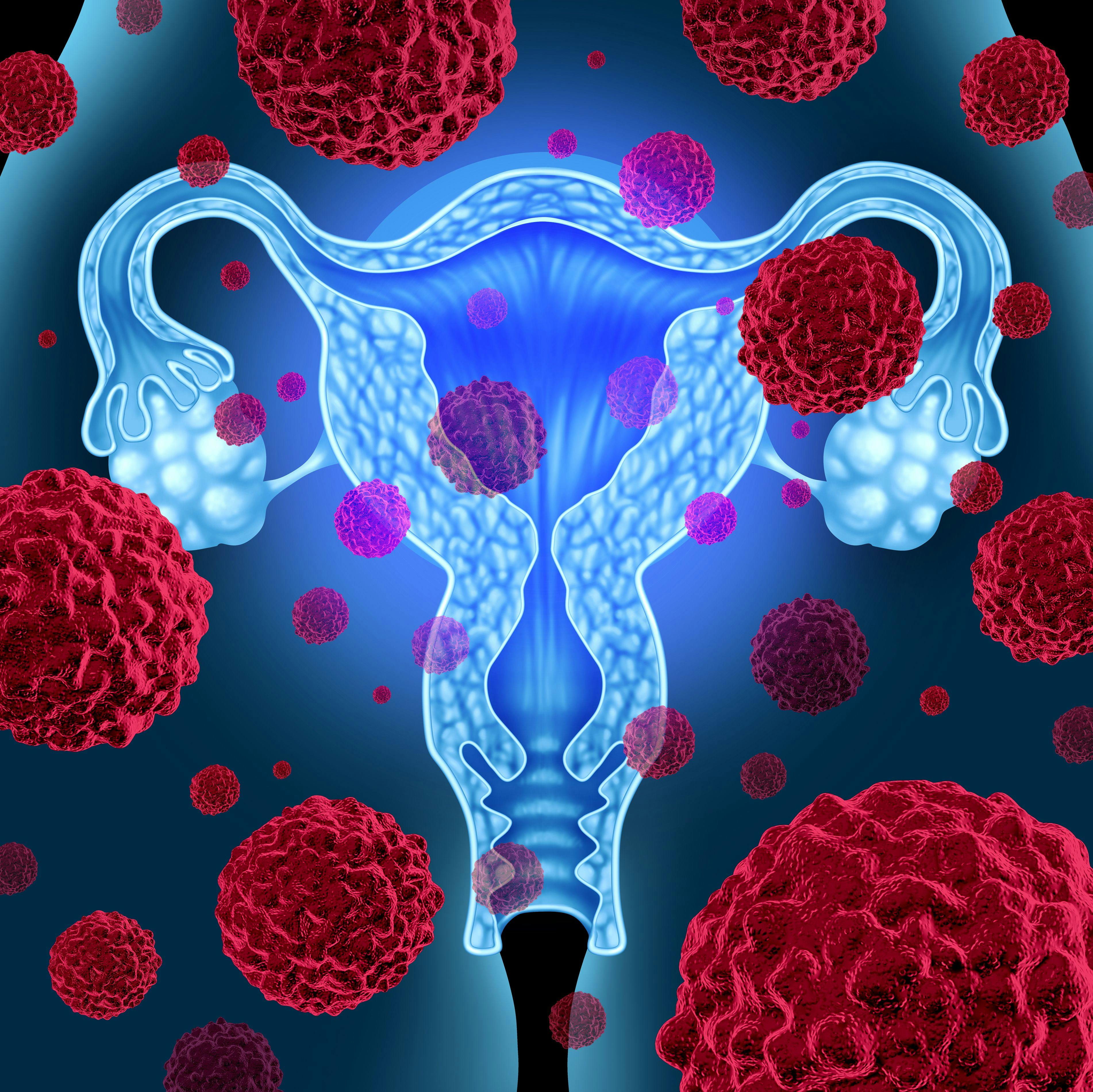 Illustration of female reproductive system and cancer cells - stock.adobe.com