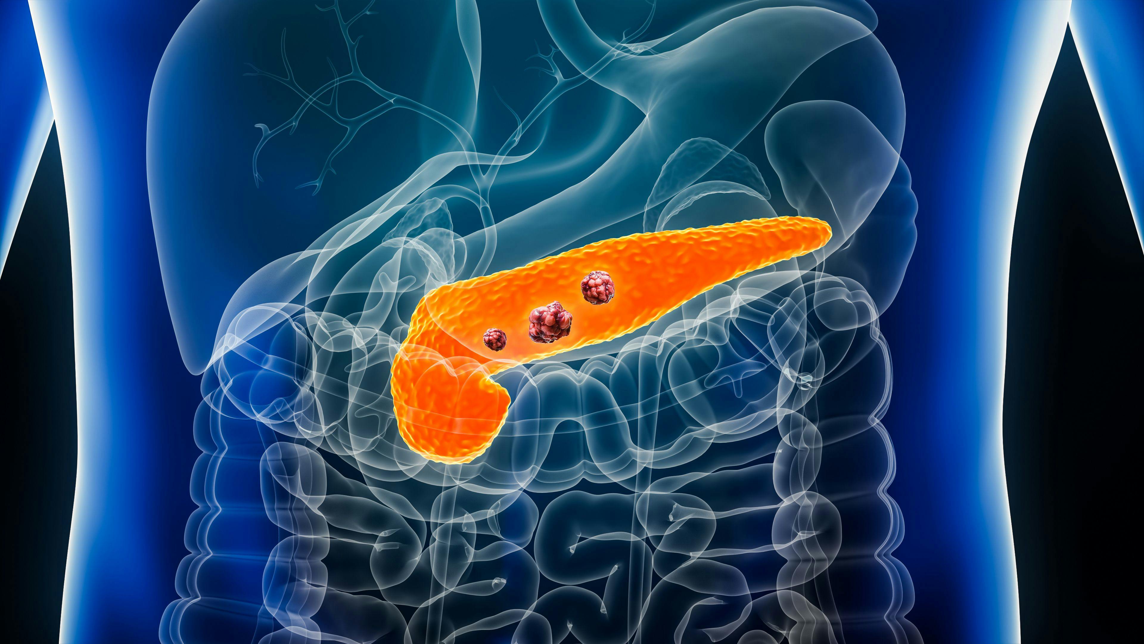 Pancreas or pancreatic cancer with organs and tumors or cancerous cells 3D rendering illustration with male body. Anatomy, oncology, disease, medical: © matthieu - stock.adobe.com