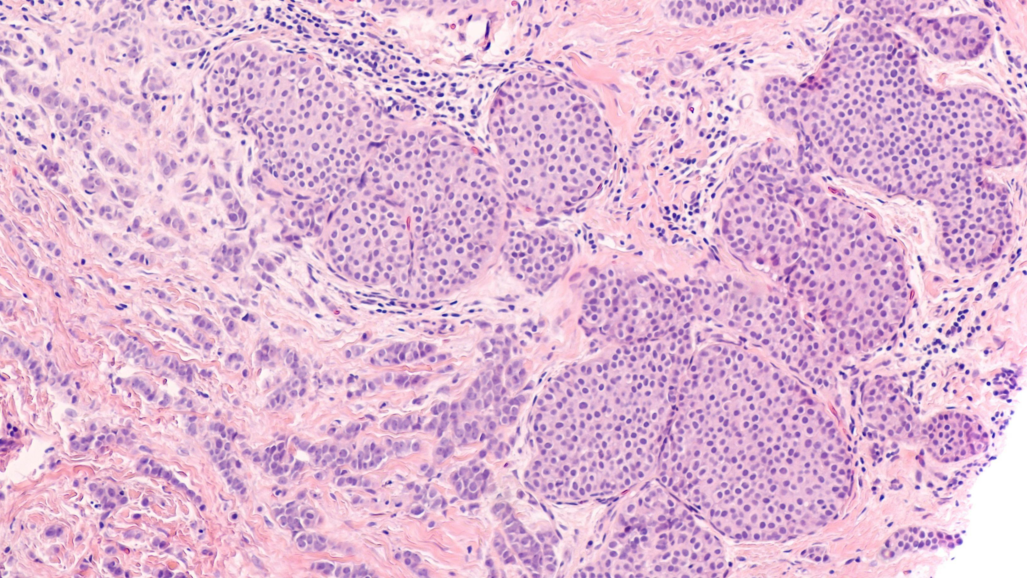 Breast cancer histology: Lobular carcinoma in situ (LCIS) is seen in the lower left with invasive (infiltrating) lobular carcinoma in the upper right. Screening mammography can detect early tumors. | Image Credit: © David A. Litman - www.stock.adobe.com