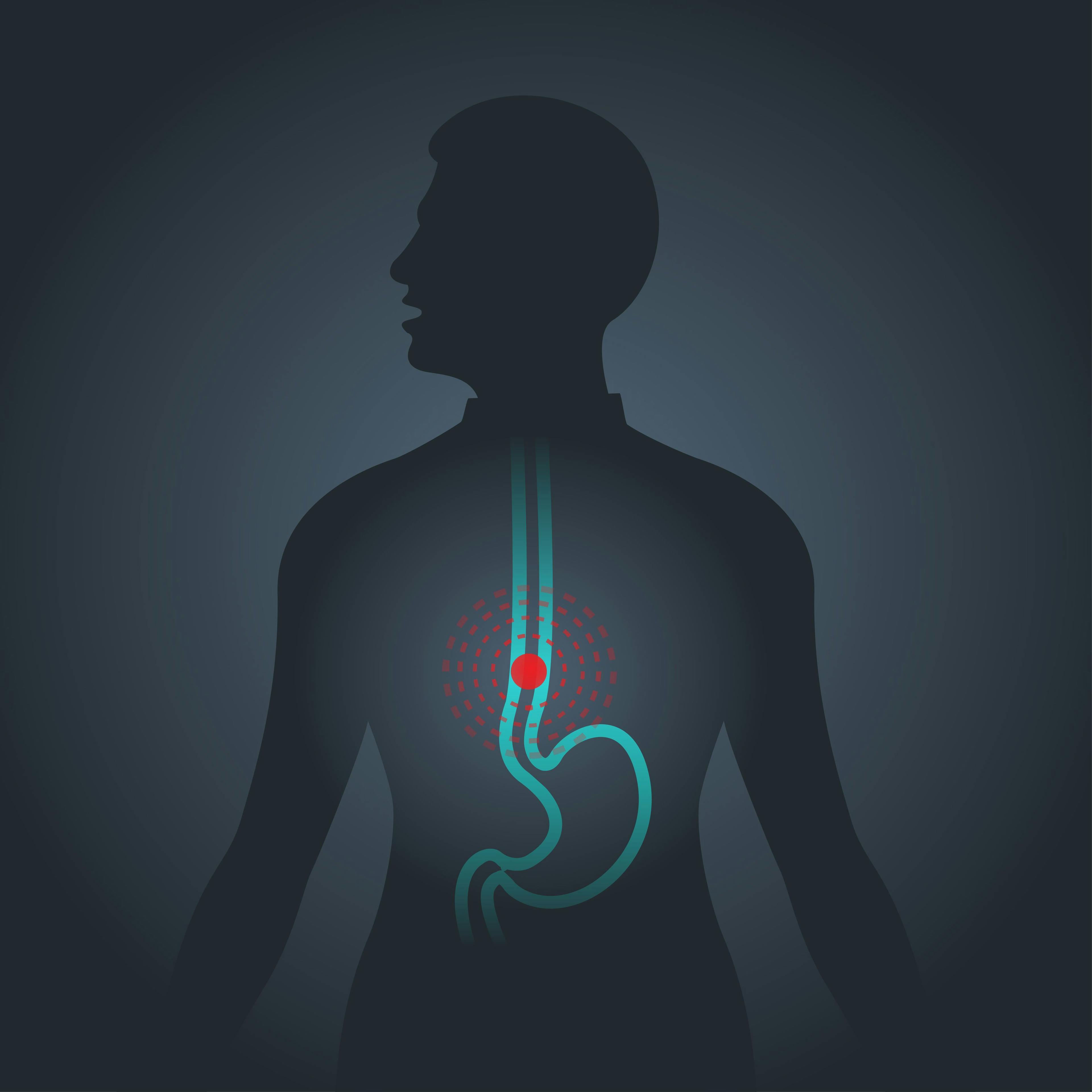 Illustration of esophageal cancer: © ilovecoffeedesign - stock.adobe.com
