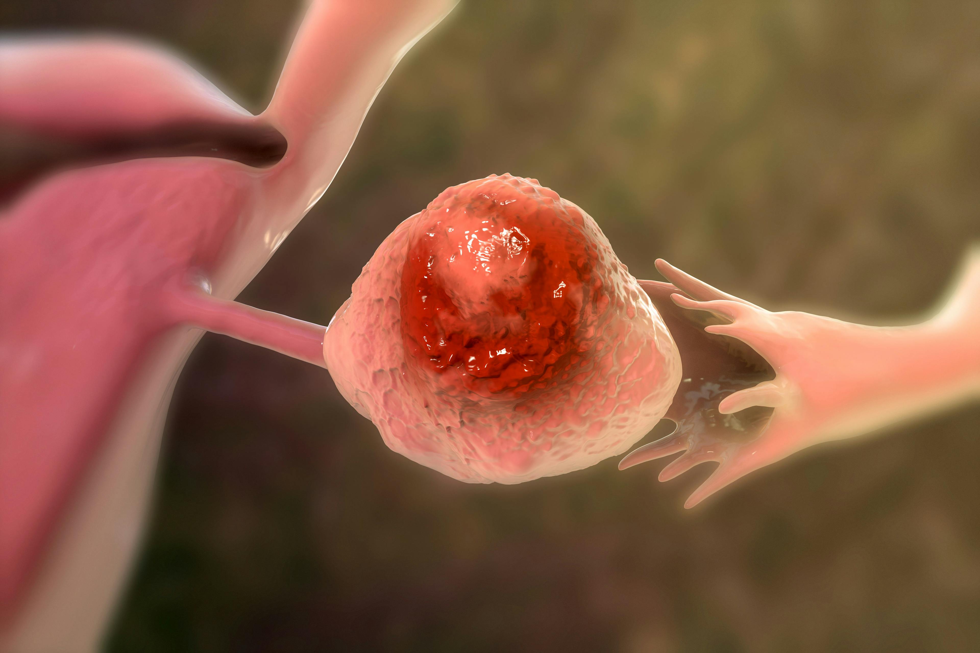 Illustration of ovarian caner: ©Dr_Microbe - stock.adobe.com