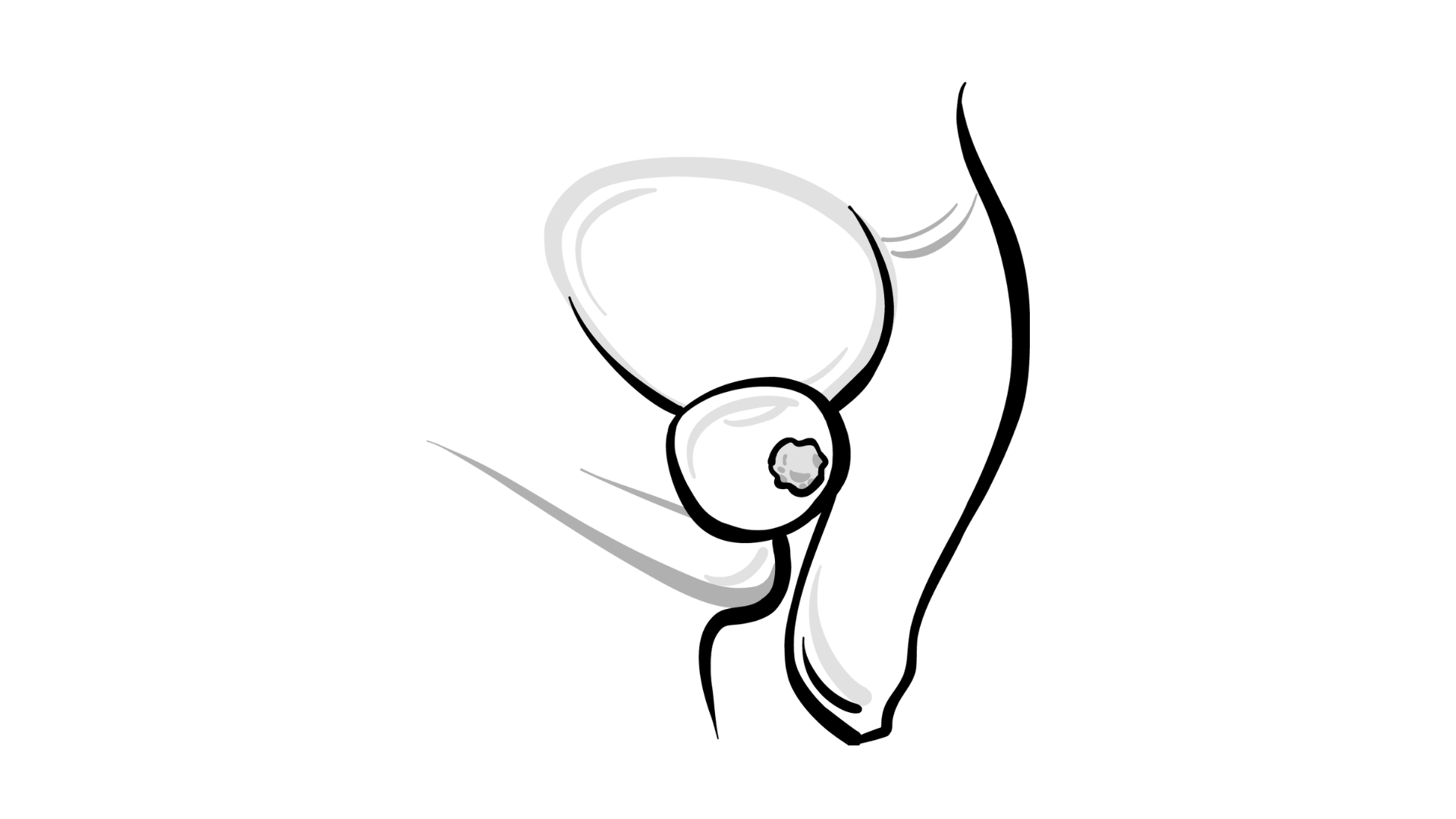 Sketch of prostate