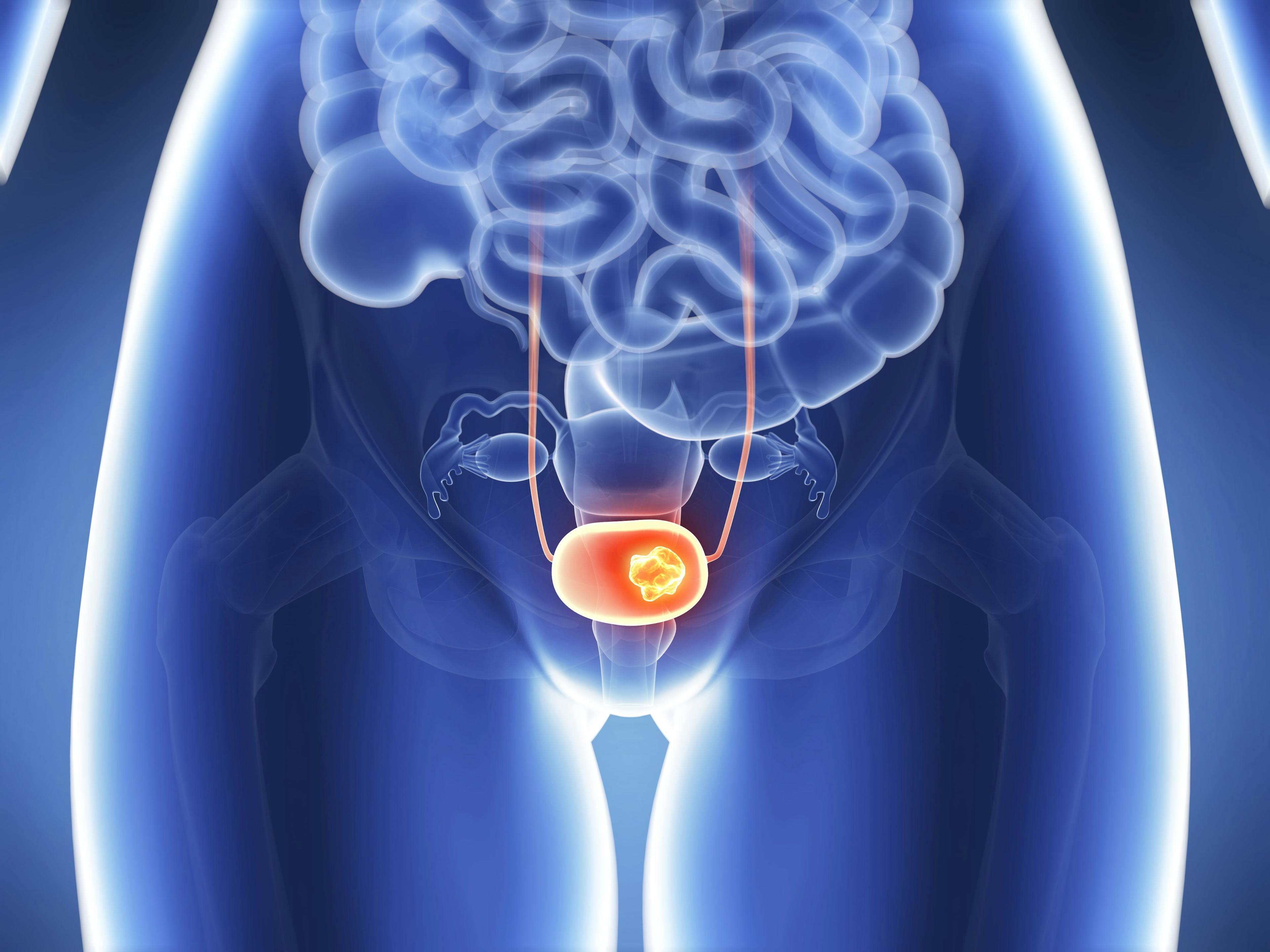 3D rendering of bladder cancer: ©SciePro - stock.adobe.com