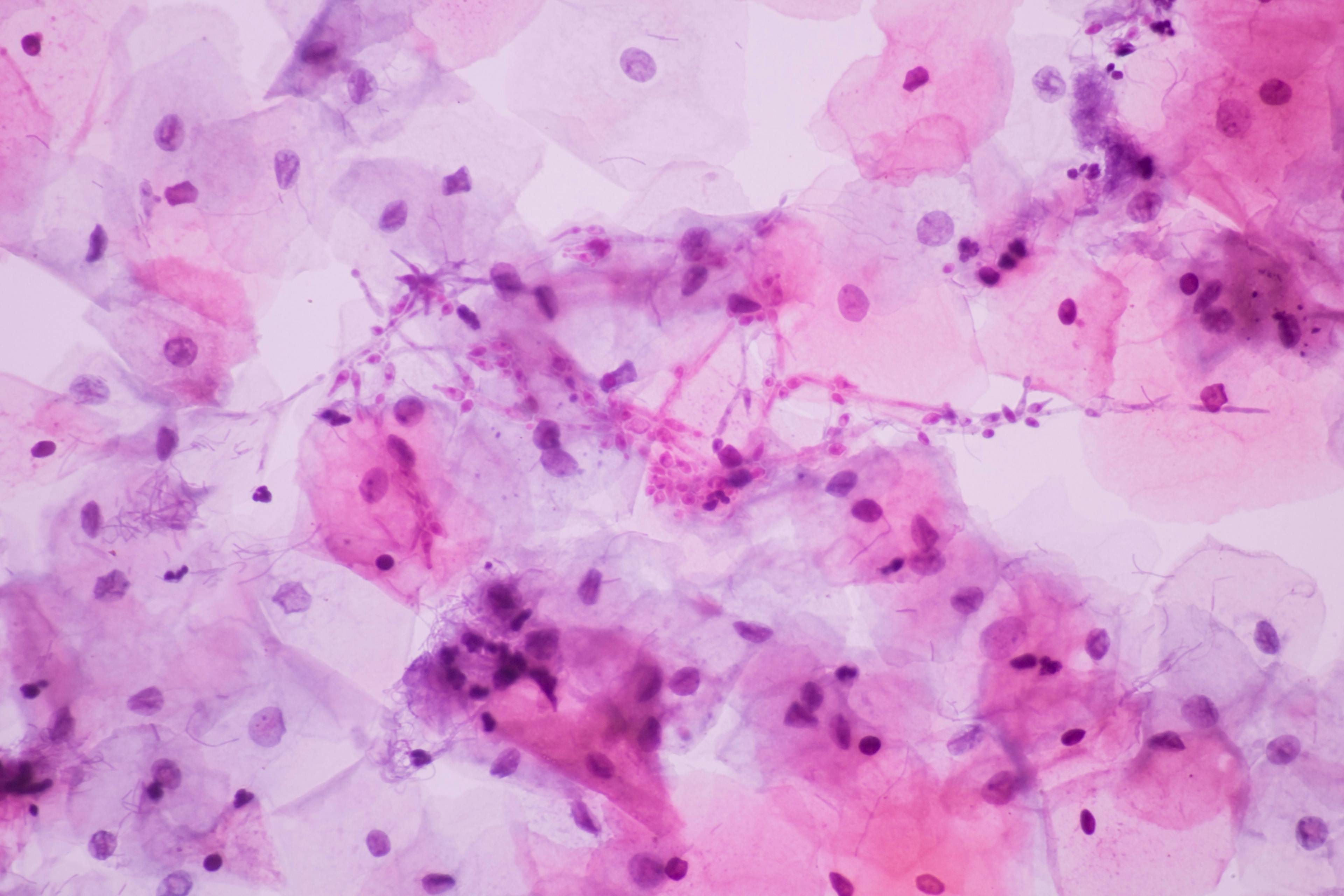 Image of gynecologic cancer cells: © arcyto - stock.adobe.com