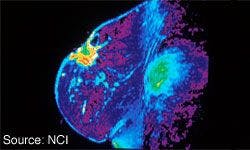 Gadobutrol Approved for MRI Evaluation of Breast Cancer