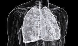 MAGE-A3 Immunotherapeutic Fails to Improve DFS in NSCLC