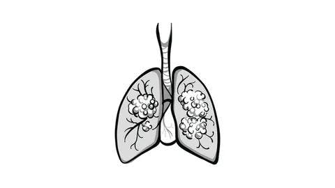 Carrizosa Explores Trials of Immunotherapy in Extensive-Stage Small Cell Lung Cancer