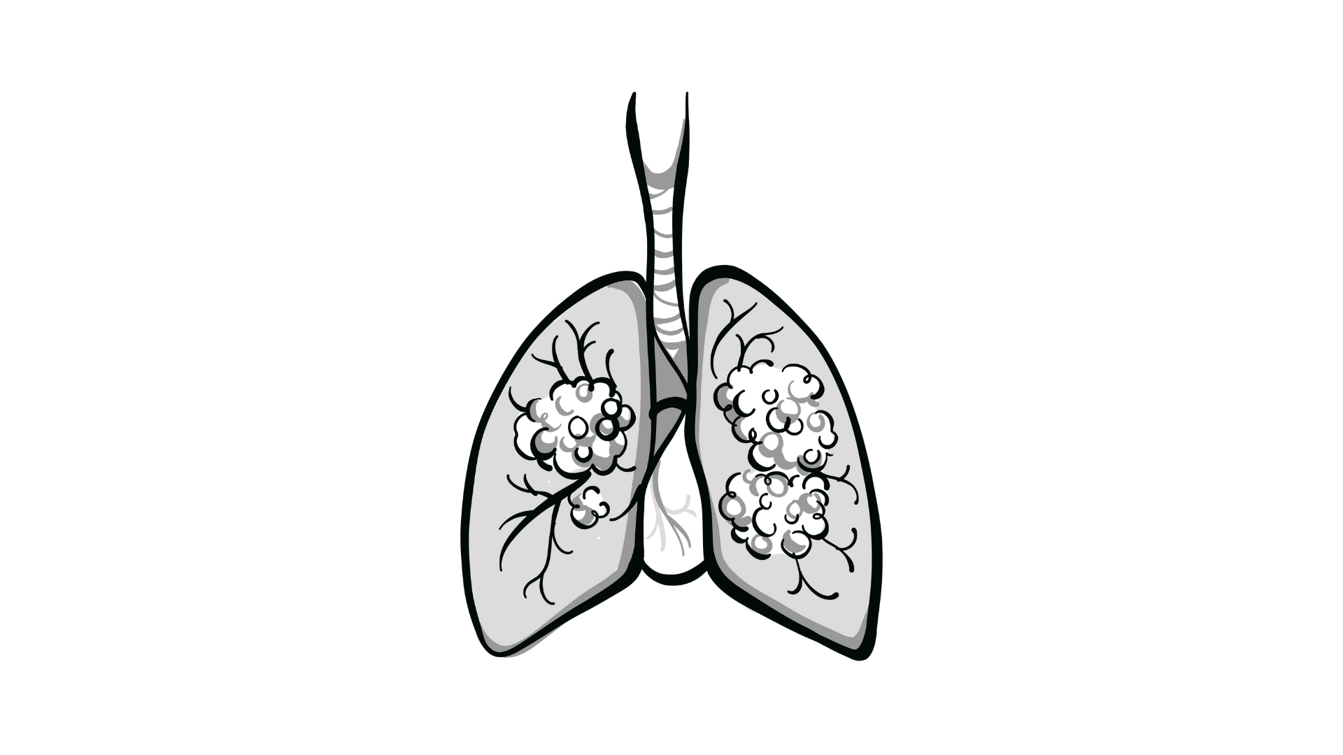 Dato-DXd Misses Significance for OS in Advanced Non-Small Cell Lung Cancer