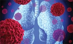 Serum Metabolite Concentrations May Prove Useful for Lung Cancer Detection