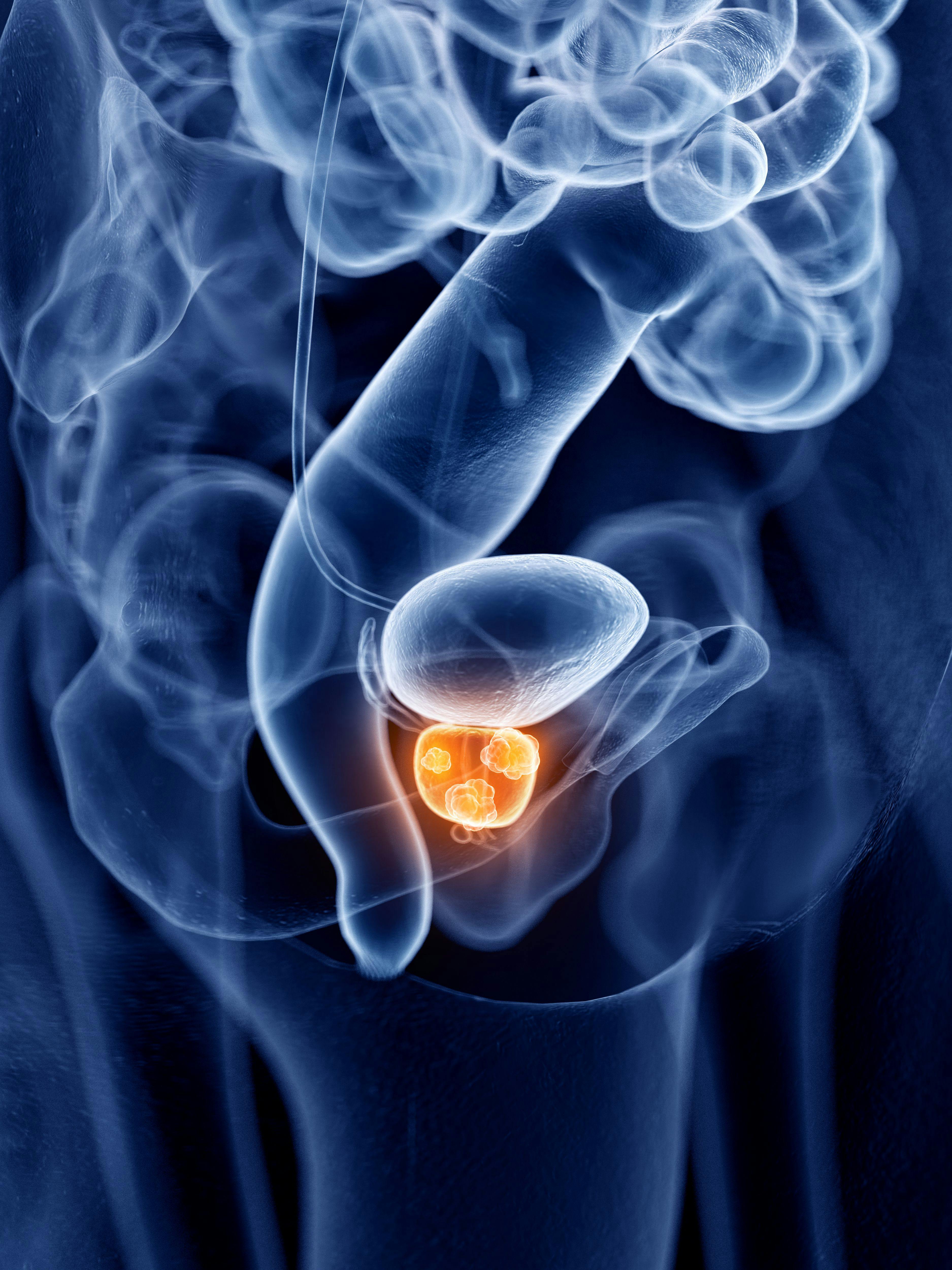 prostate cancer, prostate adenocarcinoma