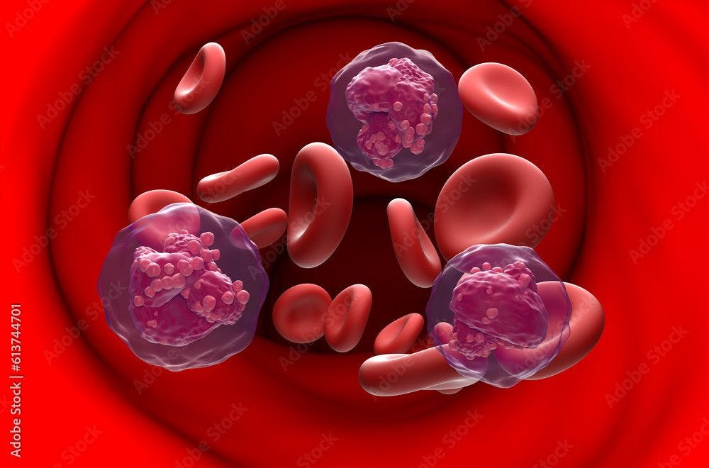 Acute lymphoblastic leukemia cancer cell in blood flow © LASZLO - stock.adobe.com