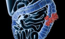 3D rendering of intestinal cancer - stock.adobe.com