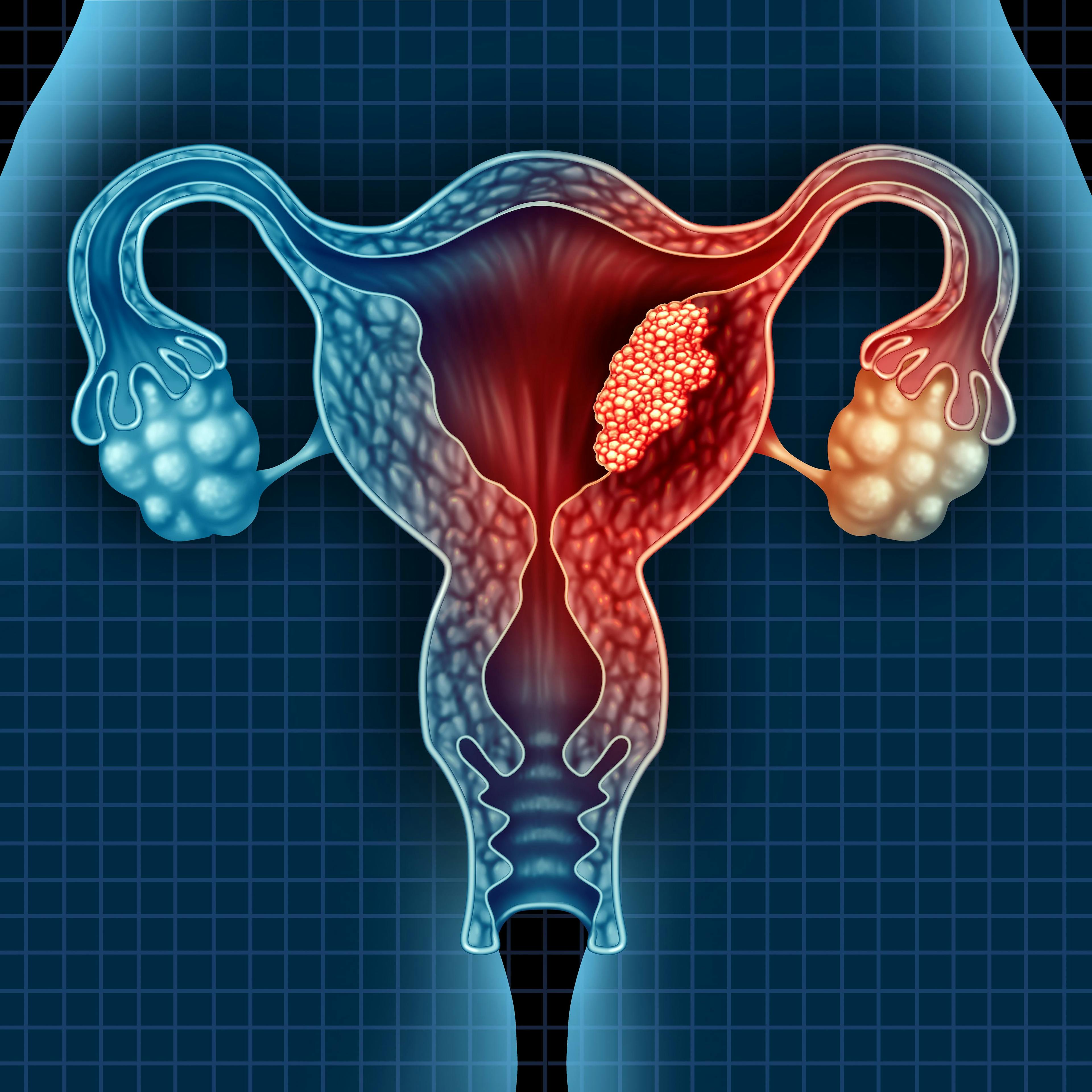 Illustration of endometrial cancer - stock.adobe.com