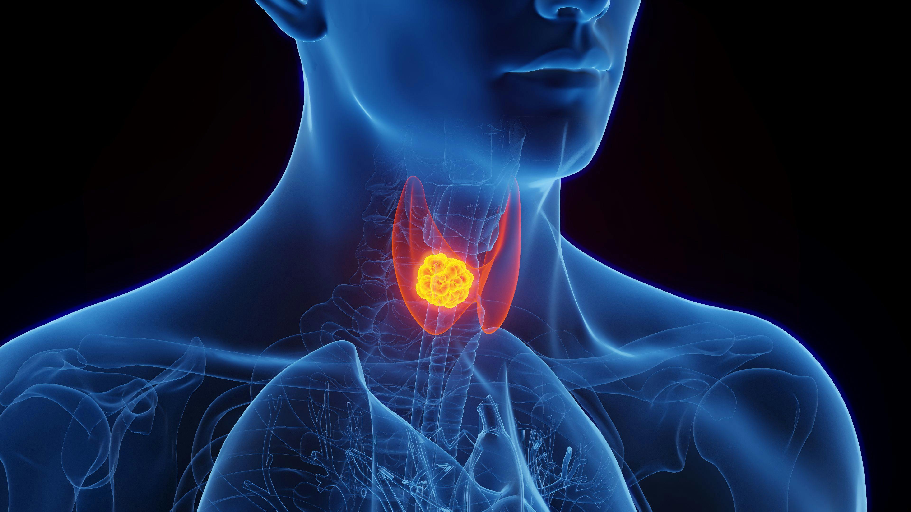 Image Credit: © SciePro - www.stock.adobe.com |  3D Rendered Medical Illustration of Male Anatomy - Thyroid Cancer.
