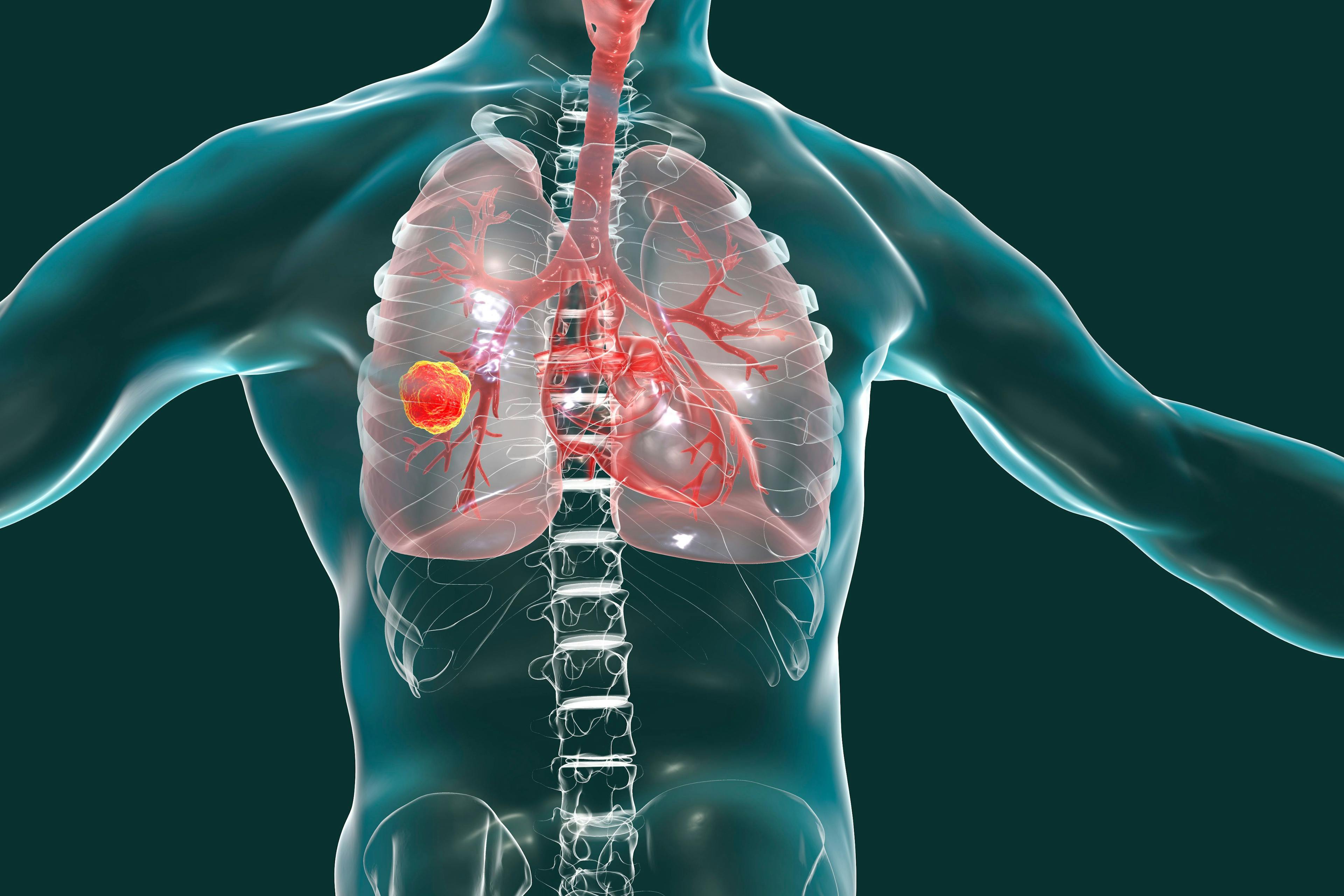 Lung cancer 3D Illustration © Dr_Microbe - stock.adobe.com