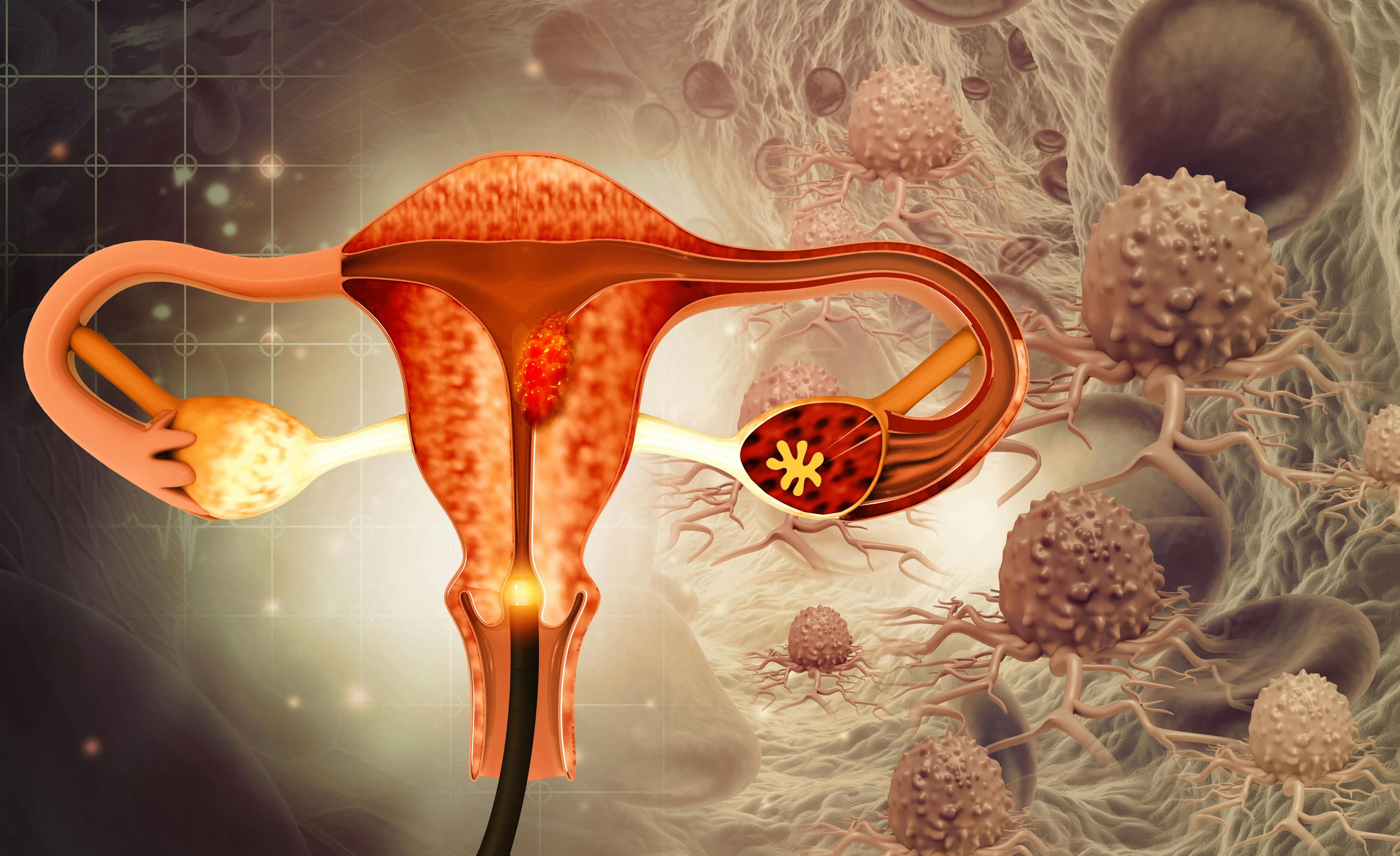 Gynecologic Cancer Illustration: © Crystal Light - stock.adobe.com