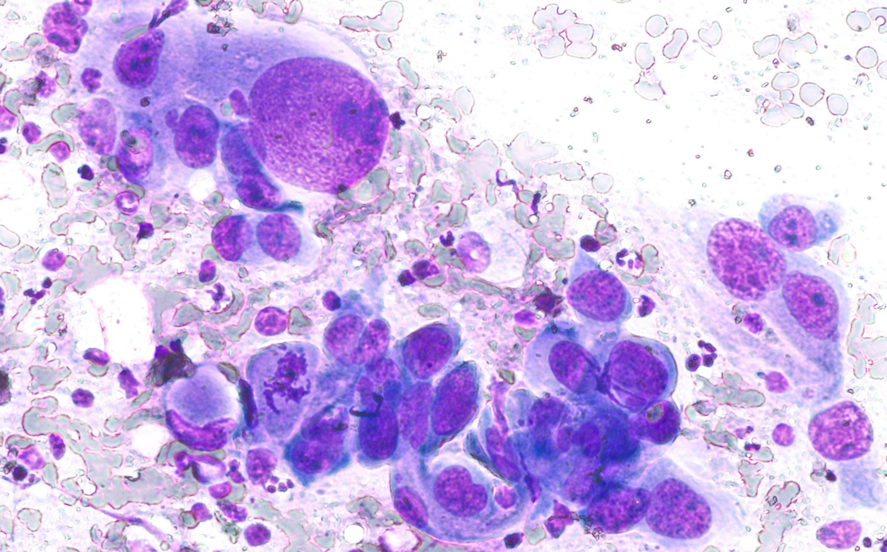 Phogomicrograph of fine needle aspiration (FNA) cytology of a pulmonary (lung) nodule showing adenocarcinoma, a type of non small cell carcinoma.| Image Credit: © David A Litman -www.stock.adobe.com