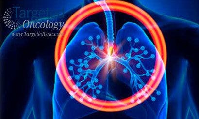 Treatment Strategies With NTRK Gene Rearrangements Emerge in Lung and Other Solid Tumors