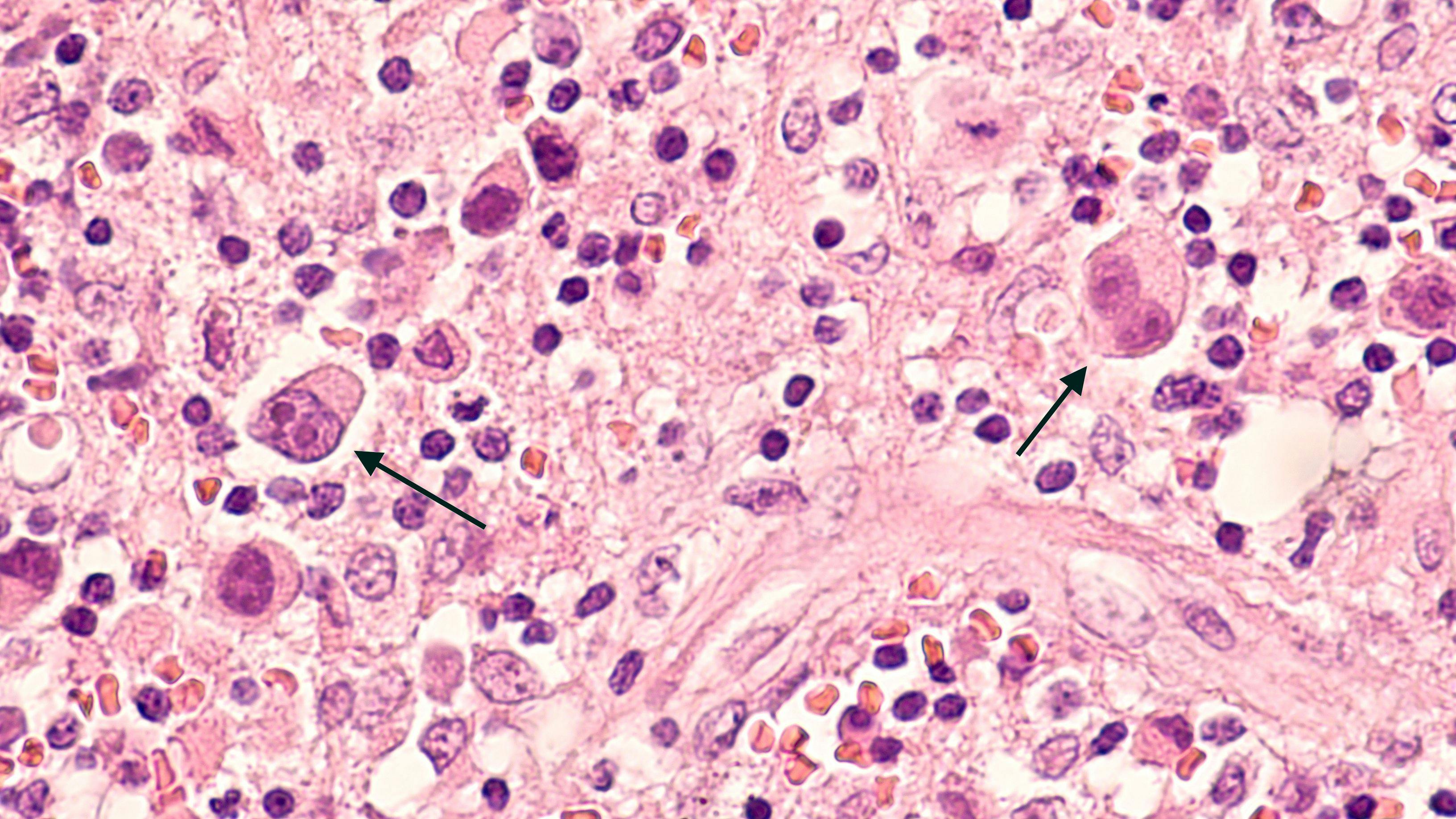 Microscopic image of a lymph node in a patient with Hodgkin's Disease (lymphoma), showing two Reed Sternberg cells in the same field. | Image Credit: © David A Litman - www.stock.adobe.com