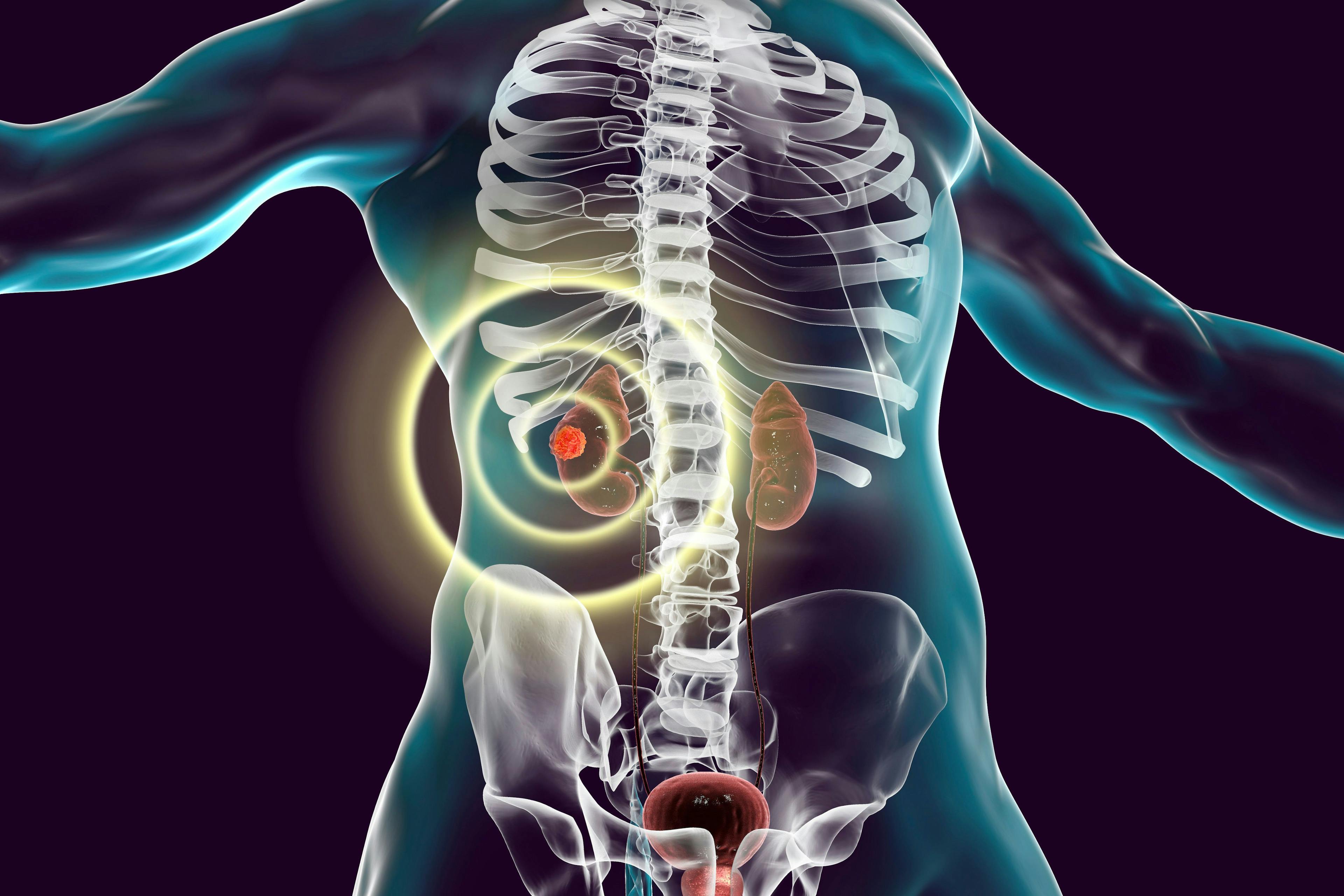 Illustration of renal cell carcinoma: ©DrMicrobe - stock.adobe.com